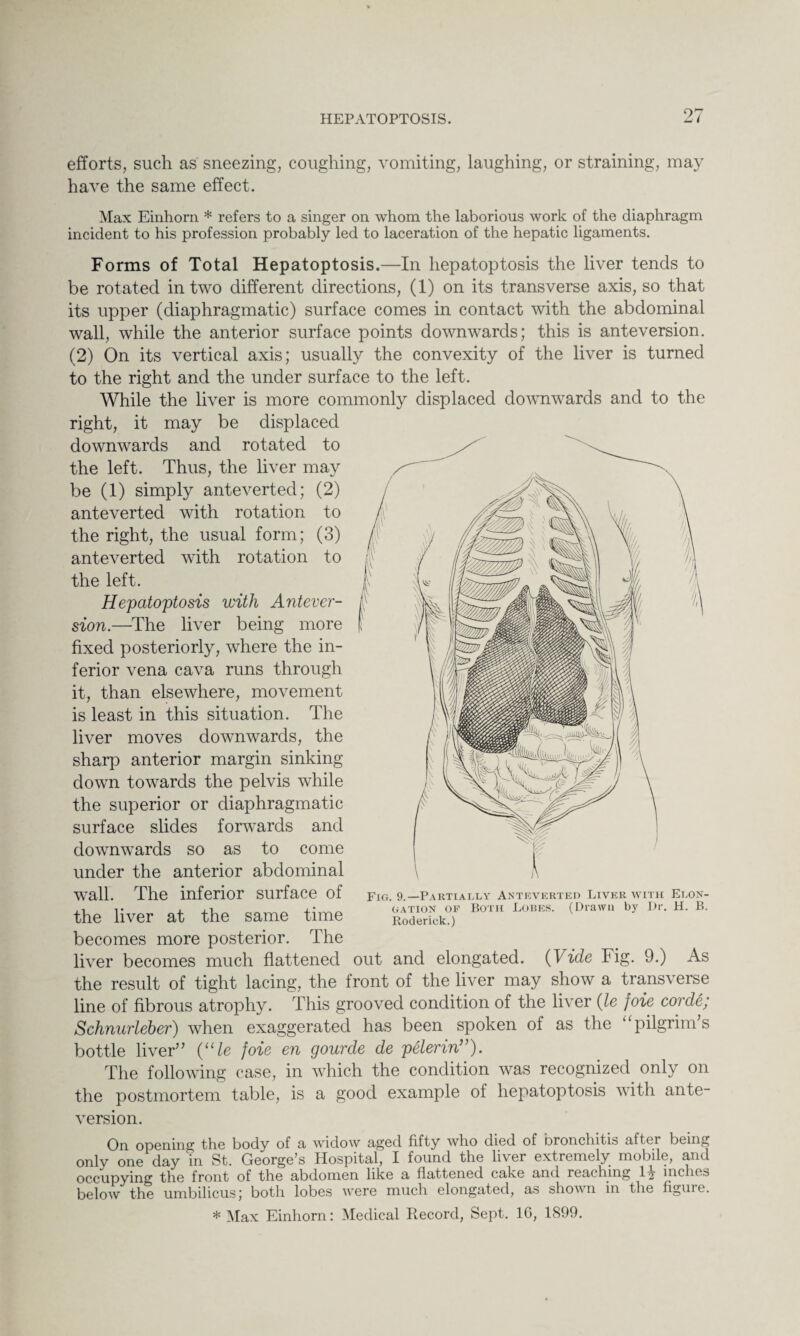 efforts, such as sneezing, coughing, vomiting, laughing, or straining, may have the same effect. Max Einhorn * refers to a singer on whom the laborious work of the diaphragm incident to his profession probably led to laceration of the hepatic ligaments. Forms of Total Hepatoptosis.—In hepatoptosis the liver tends to be rotated in two different directions, (1) on its transverse axis, so that its upper (diaphragmatic) surface comes in contact with the abdominal wall, while the anterior surface points downwards; this is anteversion. (2) On its vertical axis; usually the convexity of the liver is turned to the right and the under surface to the left. While the liver is more commonly displaced downwards and to the right, it may be displaced downwards and rotated to the left. Thus, the liver may be (1) simply anteverted; (2) anteverted with rotation to the right, the usual form; (3) anteverted with rotation to the left. Hepatoptosis with Antever¬ sion.—The liver being more fixed posteriorly, where the in¬ ferior vena cava runs through it, than elsewhere, movement is least in this situation. The liver moves downwards, the sharp anterior margin sinking down towards the pelvis while the superior or diaphragmatic surface slides forwards and downwards so as to come under the anterior abdominal wall. The inferior surface of the liver at the same time becomes more posterior. The liver becomes much flattened out and elongated. (1ide Fig. 9.) As the result of tight lacing, the front of the liver may show a trans\ erse line of fibrous atrophy. This grooved condition of the liver (le foie corde; Schnurleber) when exaggerated has been spoken of as the “pilgrims bottle liver” (“le foie en gourde de pelerin”). The following case, in which the condition was recognized only on the postmortem table, is a good example of hepatoptosis with ante- version. On opening the body of a widow aged fifty who died of bronchitis after being only one day in St. George’s Hospital, I found the liver extremely mobile, and occupying the front of the nbdomcn like flattened, enke &nd rcnching 1 j incurs below the umbilicus; both lobes were much elongated, as shown in the figuie. * Max Einhorn: Medical Record, Sept. 16, 1899. Fig. 9.—Partially Anteverted Liver with Elon¬ gation of Both Lobes. (Drawn by Dr. H. B. Roderick.)