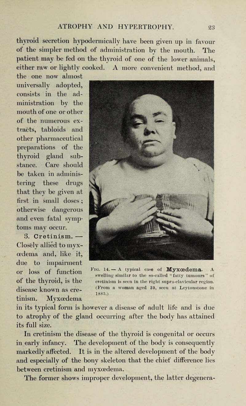 thyroid secretion hypodermically have been given up in favour of the simpler method of administration by the mouth. The patient may be fed on the thyroid of one of the lower animals, either raw or lightly cooked. A more convenient method, and the one now almost universally adopted, consists in the ad¬ ministration by the mouth of one or other of the numerous ex¬ tracts, tabloids and other pharmaceutical preparations of the thyroid gland sub¬ stance. Care should be taken in adminis¬ tering these drugs that they be given at first in small doses ; otherwise dangerous and even fatal symp¬ toms may occur. 3. Cretinism. — Closely allied to myx- oedema and, like it, due to impairment or loss of function F,u- ~A c:,se °* Myxoedema. A swelling-similar to the so-called “fatty tumours ot of the thyi’Old, is the cretinism is seen in the right supra-clavicular region. disease known as ere- (From a woman aged 39, seeu at Leytonstone in 1885.) tinism. Myxoedema in its typical form is however a disease of adult life and is due to atrophy of the gland occurring after the body has attained its full size. In cretinism the disease of the thyroid is congenital or occurs in early infancy. The development of the body is consequently markedly affected. It is in the altered development of the body and especially of the bony skeleton that the chief difference lies between cretinism and myxoedema. The former shows improper development, the latter degenera-