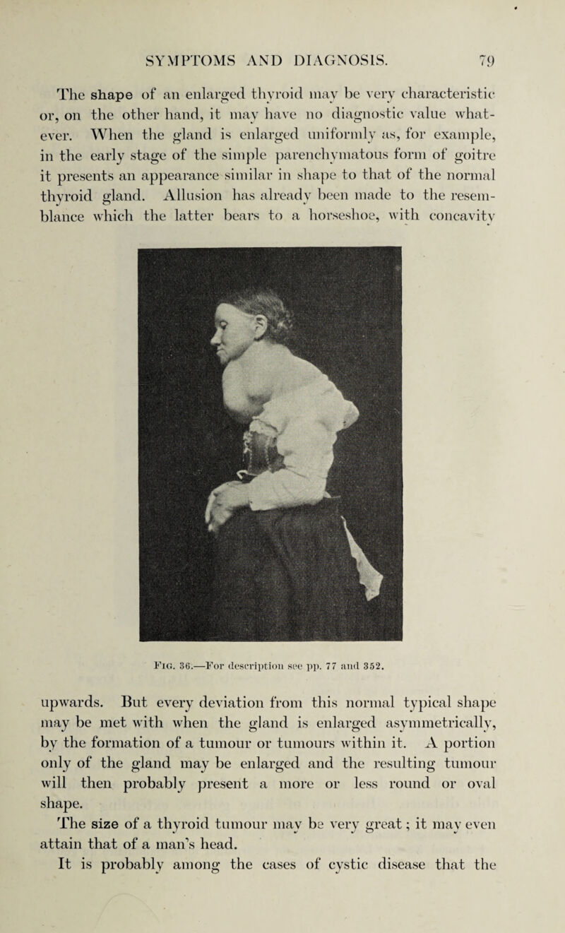 The shape of an enlarged thyroid may be very characteristic or, on the other hand, it may have no diagnostic value what¬ ever. When the gland is enlarged uniformly as, for example, in the early stage of the simple parenchymatous form of goitre it presents an appearance similar in shape to that of the normal thyroid gland. Allusion has already been made to the resem¬ blance which the latter bears to a horseshoe, with concavity Fig. 36.—For description see pp. 77 and 352. upwards. But every deviation from this normal typical shape may be met with when the gland is enlarged asymmetrically, by the formation of a tumour or tumours within it. A portion only of the gland may be enlarged and the resulting tumour will then probably present a more or less round or oval shape. The size of a thyroid tumour may be very great; it may even attain that of a man’s head. It is probably among the cases of cystic disease that the