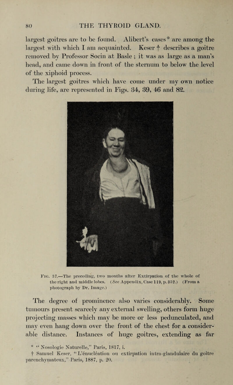 largest goitres are to be found. Alibert’s cases* are among the largest with which I am acquainted. Keser f describes a goitre removed by Professor Socin at Basle ; it was as large as a man’s head, and came down in front of the sternum to below the level of the xiphoid process. The largest goitres which have come under my own notice during life, are represented in Figs. 34, 39, 46 and 82. Fig. 37.—The preceding, two months after Extirpation of the whole of the right and middle lobes. (See Appendix, Case 119, p. 352.) (From a photograph by Dr. Image.) The degree of prominence also varies considerably. Some tumours present scarcely any external swelling, others form huge projecting masses which may be more or less pedunculated, and may even hang down over the front of the chest for a consider¬ able distance. Instances of huge goitres, extending as far *  Nosologic Naturelle,” Paris, 1817, i. j Samuel Keser, “ L’enucleation on extirpation intra-glandulaire du goitre parenchymateux,” Paris, 1887, p. 20.