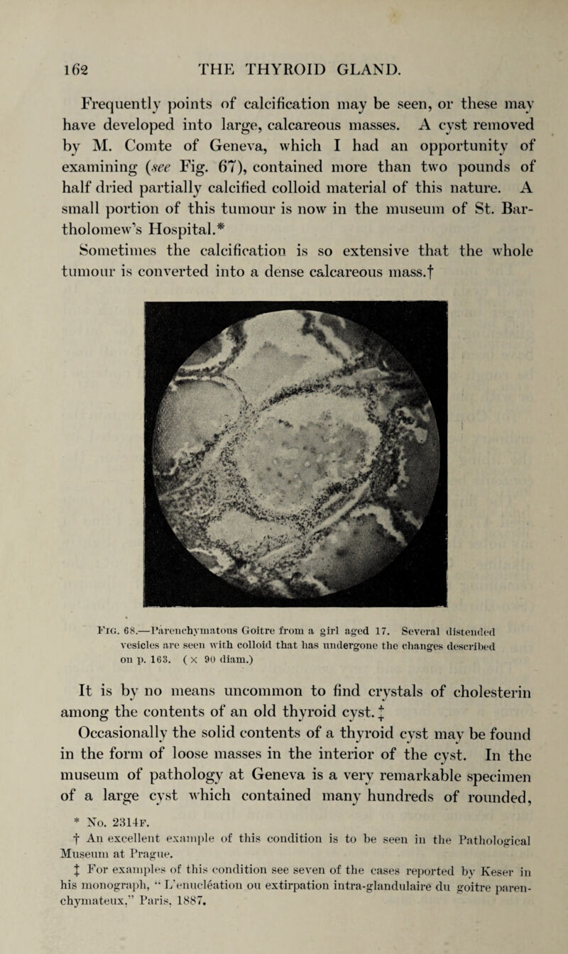 Frequently points of calcification may be seen, or these may have developed into large, calcareous masses. A cyst removed by M. Comte of Geneva, which I had an opportunity of examining (see Fig. 67), contained more than two pounds of half dried partially calcified colloid material of this nature. A small portion of this tumour is now in the museum of St. Bar¬ tholomew’s Hospital.* Sometimes the calcification is so extensive that the whole tumour is converted into a dense calcareous mass.f Fig. 68.—Parenchymatous Goitre from a girl aged 17. Several distended vesicles are seen with colloid that has undergone the changes described on p. 163. ( x 90 diam.) It is by no means uncommon to find crystals of cholesterin among the contents of an old thyroid cyst. J Occasionally the solid contents of a thyroid cyst may be found in the form of loose masses in the interior of the cyst. In the museum of pathology at Geneva is a very remarkable specimen of a large cyst which contained many hundreds of rounded, * No. 2314f. t An excellent example of this condition is to be seen in the Pathological Museum at Prague. J For examples of this condition see seven of the cases reported by Keser in his monograph, “ L’enucleation ou extirpation intra-glandulaire du goitre paren- chymateux,” Paris, 1887.