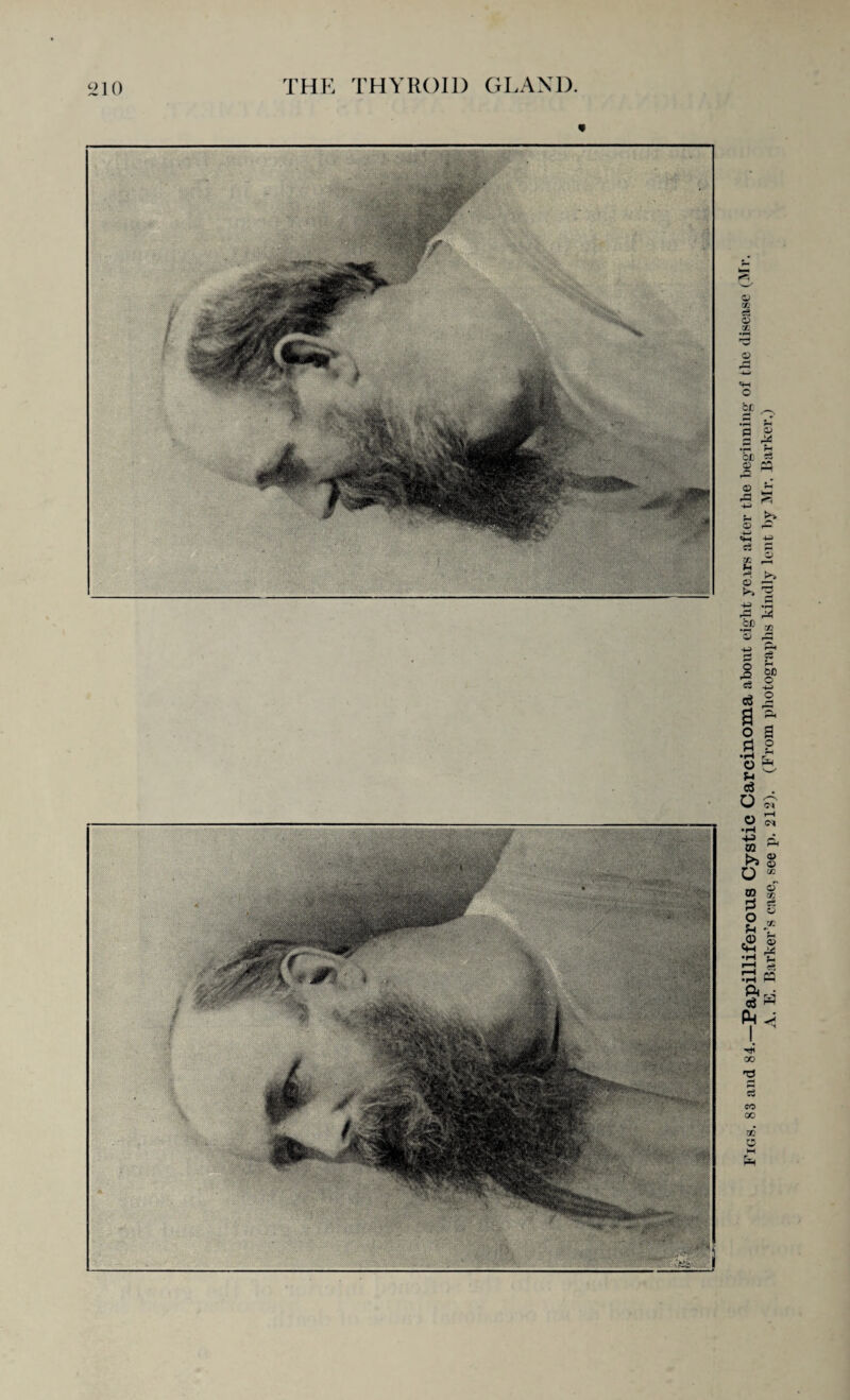 Figs. 83 and 84.—Papilliferous Cystic Carcinoma about eight years after the beginning1 of the disease (Mr. A. E. Barker’s case, see p. 212). (From photographs kindly lent lay Mr. Barker.)