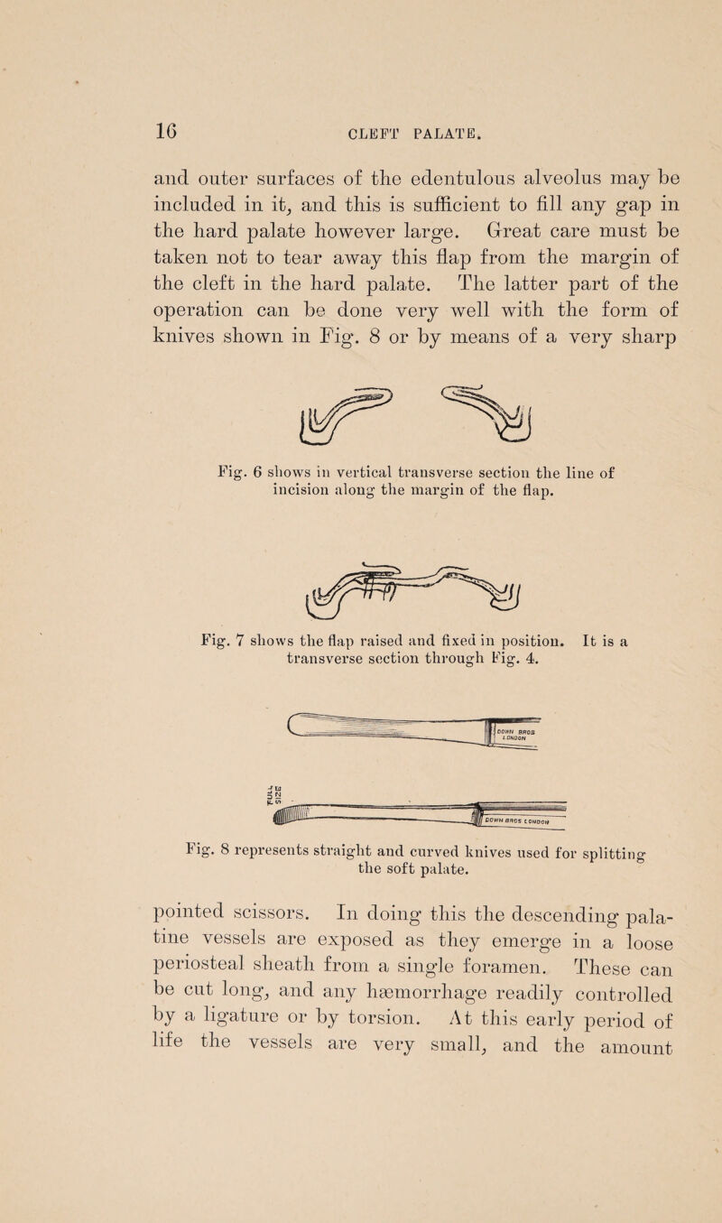 and outer surfaces of the edentulous alveolus may be included in it, and this is sufficient to fill any gap in the hard palate however large. Great care must be taken not to tear away this flap from the margin of the cleft in the hard palate. The latter part of the operation can be done very well with the form of knives shown in Fig. 8 or by means of a very sharp Fig. 6 shows in vertical transverse section the line of incision along the margin of the flap. Fig. 7 shows the flap raised and fixed in position. It is a transverse section through Fig. 4. Fig. 8 represents straight and curved knives used for splitting the soft palate. pointed scissors. In doing this the descending pala¬ tine vessels are exposed as they emerge in a loose periosteal sheath from a single foramen. These can be cut long; and any haemorrhage readily controlled by a ligature or by torsion. At this early period of life the vessels are very small; and the amount