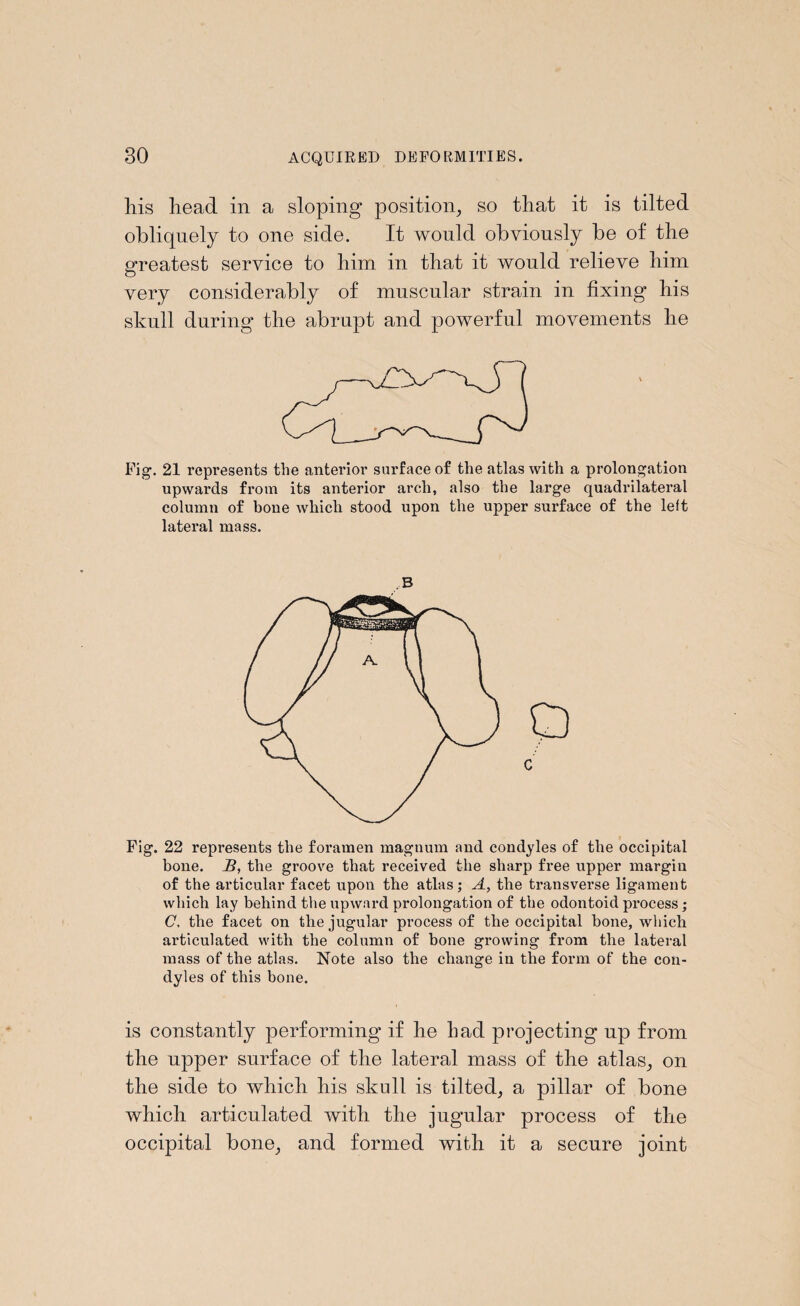 his head in a sloping position, so that it is tilted obliquely to one side. It would obviously be of the greatest service to him in that it would relieve him very considerably of muscular strain in fixing his skull during the abrupt and powerful movements he Fig-. 21 represents the anterior surface of the atlas with a prolongation upwards from its anterior arch, also the large quadrilateral column of bone which stood upon the upper surface of the left lateral mass. Fig. 22 represents the foramen magnum and condyles of the occipital bone. B, the groove that received the sharp free upper margin of the articular facet upon the atlas; A, the transverse ligament which lay behind the upward prolongation of the odontoid process; C, the facet on the jugular process of the occipital hone, which articulated with the column of bone growing from the lateral mass of the atlas. Note also the change in the form of the con¬ dyles of this bone. is constantly performing if lie bad projecting up from tlie upper surface of the lateral mass of the atlas, on the side to which his skull is tilted, a pillar of bone which articulated with the jugular process of the occipital bone, and formed with it a secure joint