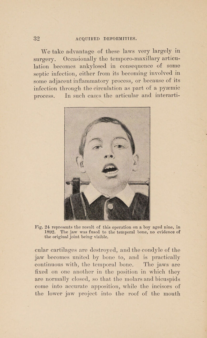 We take advantage of these laws very largely in surgery. Occasionally the temporo-maxillary articu¬ lation becomes ankylosed in consequence of some septic infection, either from its becoming involved in some adjacent inflammatory process, or because of its infection through the circulation as part of a pyaemic process. In such cases the articular and interarti- Fig. 24 represents the result of this operation on a hoy aged nine, in 1892. The jaw was fused to the temporal bone, no evidence of the original joint being visible. cular cartilages are destroyed, and the condyle of the jaw becomes united by bone to, and is practically continuous with, the temporal bone. The jaws are fixed on one another in the position in which they are normally closed, so that the molars and bicuspids come into accurate apposition, while the incisors of the lower jaw project into the roof of the mouth