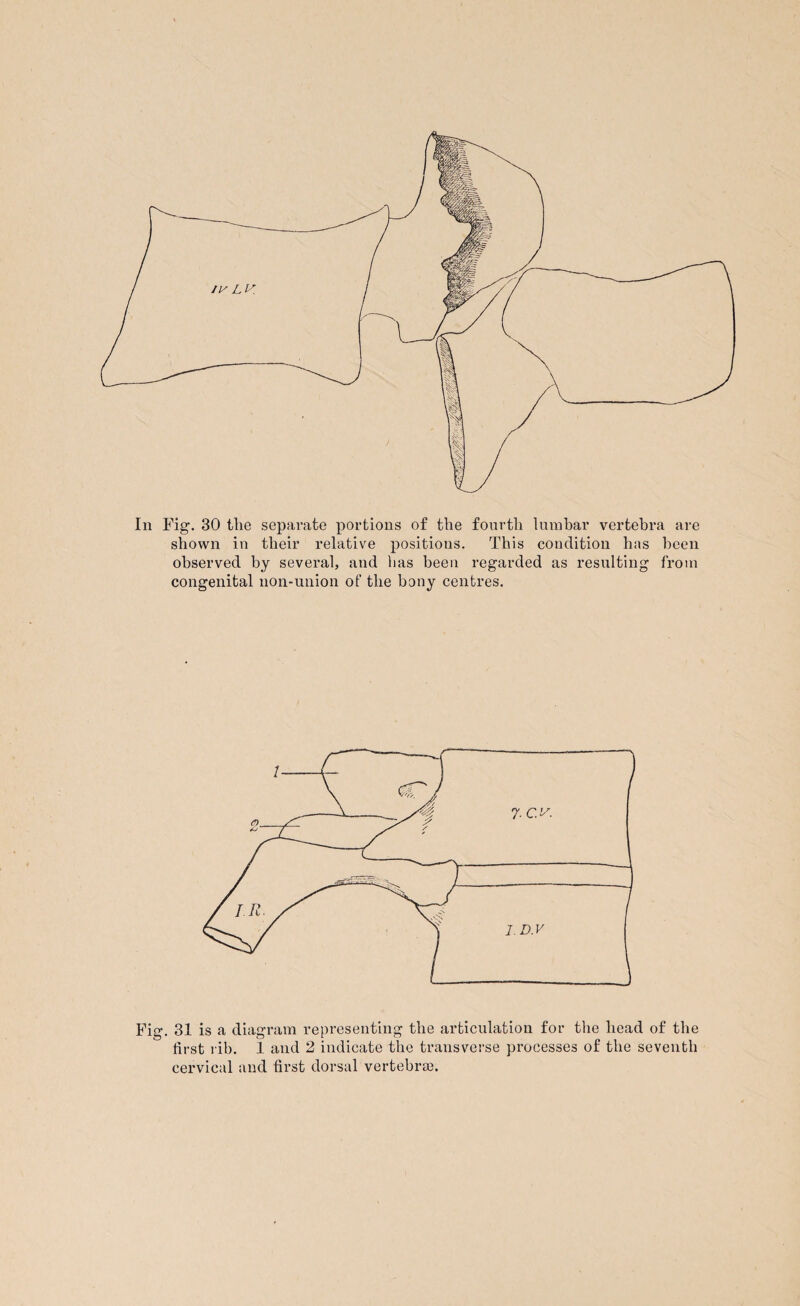 Iii Fig. 30 tlie separate portions of the fourth lumbar vertebra are shown in their relative positions. This condition has been observed by several, and has been regarded as resulting from congenital non-union of the bony centres. Fig. 31 is a diagram representing the articulation for the head of the first rib. 1 and 2 indicate the transverse processes of the seventh cervical and first dorsal vertebral.