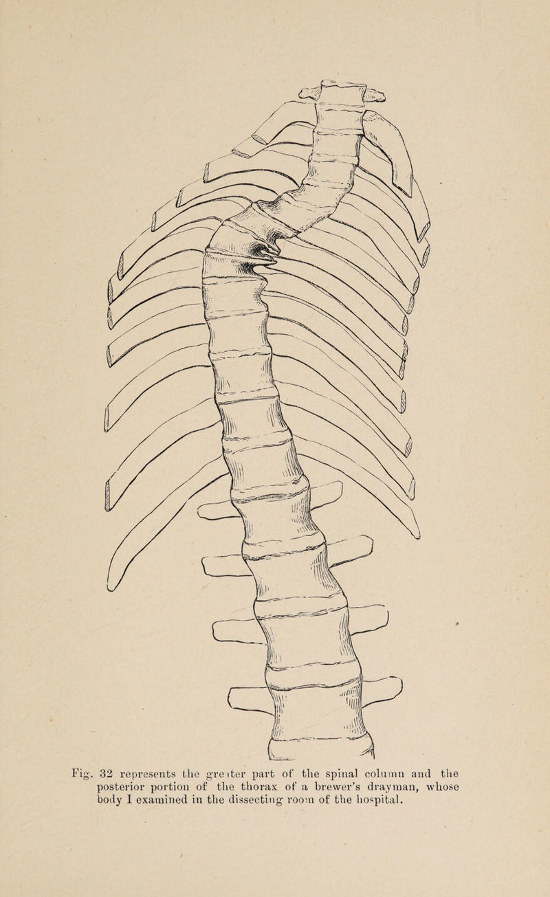 posterior portion of the thorax of a brewer’s drayman, whose body I examined in the dissecting room of the hospital.