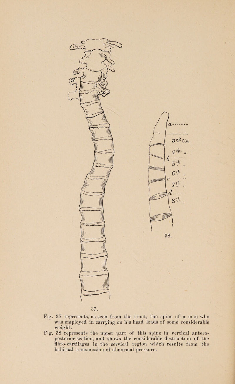 37. Fig. 37 represents, as seen from the front, the spine of a man who was employed in carrying on his head loads of some considerable weight. Fig. 38 represents the upper part of this spine in vertical antero¬ posterior section, and shows the considerable destruction of the fibro-cartilages in the cervical region which results from the habitual transmission of abnormal pressure.