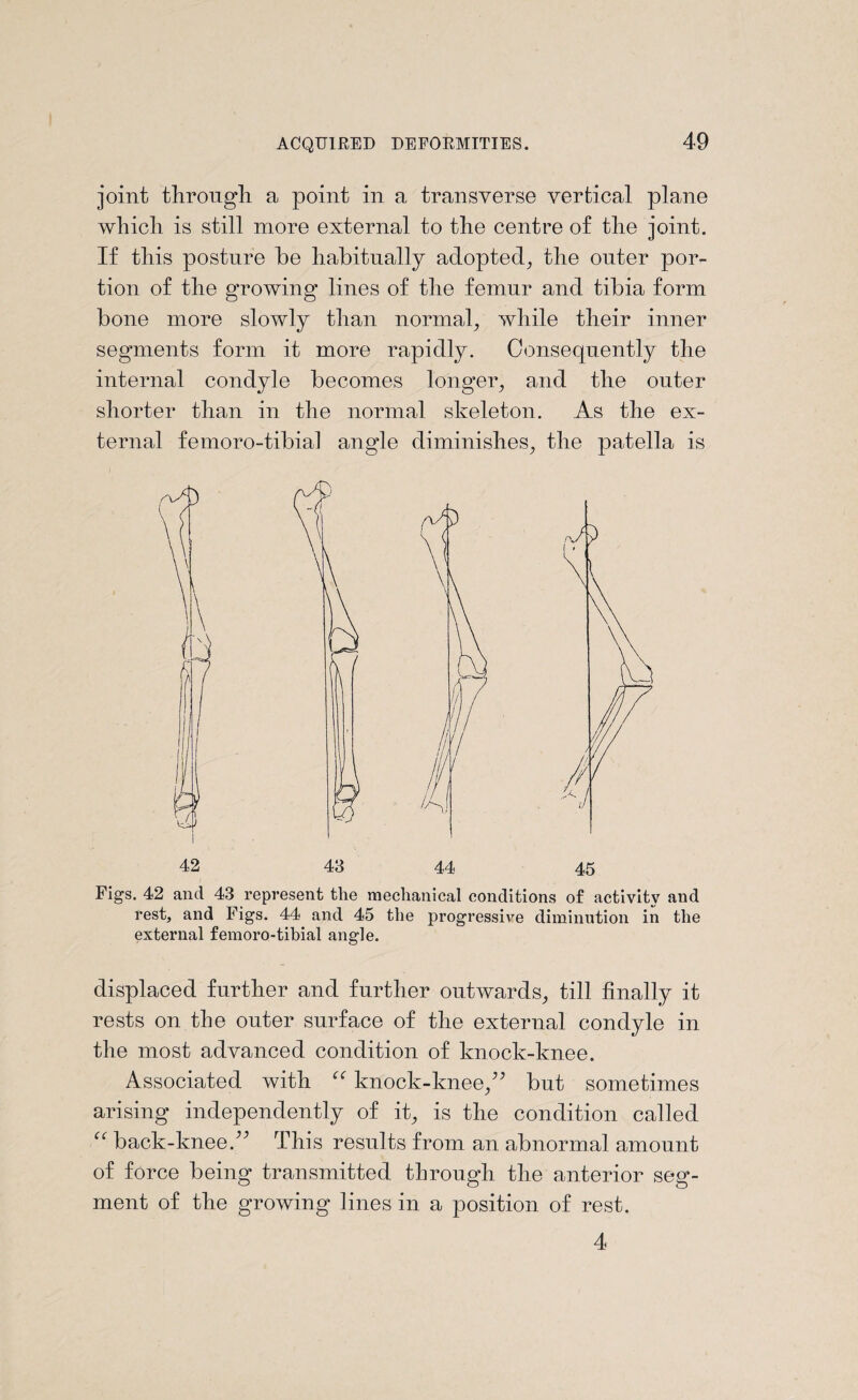 joint through a point in a transverse vertical plane which is still more external to the centre of the joint. If this posture be habitually adopted, the outer por¬ tion of the growing lines of the femur and tibia form bone more slowly than normal, while their inner segments form it more rapidly. Consequently the internal condyle becomes longer, and the outer shorter than in the normal skeleton. As the ex¬ ternal femoro-tibial angle diminishes, the patella is 42 43 44 45 Figs. 42 and 43 represent the mechanical conditions of activity and rest, and Figs. 44 and 45 the progressive diminution in the external femoro-tibial angle. displaced further and further outwards, till finally it rests on the outer surface of the external condyle in the most advanced condition of knock-knee. Associated with “ knock-knee,” but sometimes arising independently of it, is the condition called “ back-knee.” This results from an abnormal amount of force being transmitted through the anterior seg¬ ment of the growing lines in a position of rest. 4