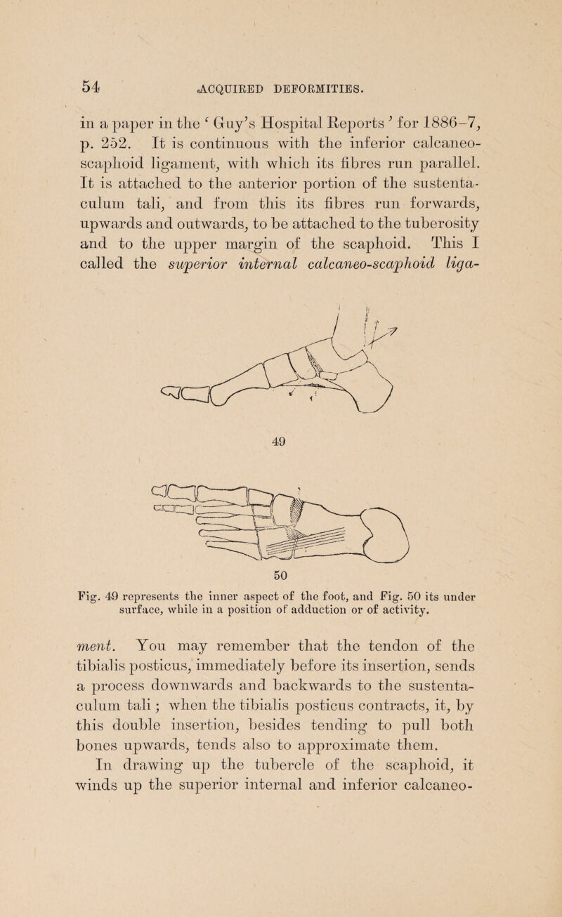 in a paper in the ‘ Gay’s Hospital Reports 3 for 1886-7, p. 252. It is continuous with the inferior calcaneo- scaphoid ligament, with which its fibres run parallel. It is attached to the anterior portion of the sustenta¬ culum tali, and from this its fibres run forwards, upwards and outwards, to be attached to the tuberosity and to the upper margin of the scaphoid. This I cailed the superior internal calcaneo-scaphoicl liga- Fig. 49 represents the inner aspect of the foot, and Fig. 50 its under surface, while in a position of adduction or of activity. ment. You may remember that the tendon of the tibialis posticus, immediately before its insertion, sends a process downwards and backwards to the sustenta¬ culum tali; when the tibialis posticus contracts, it, by this double insertion, besides tending to pull both bones upwards, tends also to approximate them. In drawing up the tubercle of the scaphoid, it winds up the superior internal and inferior calcaneo-
