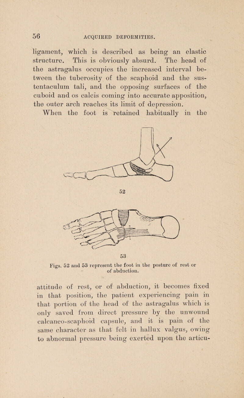 ligament^ which is described as being an elastic structure. This is obviously absurd. The head of the astragalus occupies the increased interval be¬ tween the tuberosity of the scaphoid and the sus¬ tentaculum tali; and the opposing surfaces of the cuboid and os calcis coming into accurate apposition; the outer arch reaches its limit of depression. When the foot is retained habitually in the 52 attitude of rest; or of abduction; it becomes fixed in that position; the patient experiencing pain in that portion of the head of the astragalus which is only saved from direct pressure by the unwound calcaneo-scaphoid capsule; and it is pain of the same character as that felt in hallux valgus, owing to abnormal pressure being exerted upon the articu-