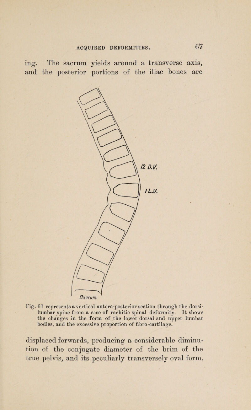 ing. The sacrum yields arouud a transverse axis, and the posterior portions of the iliac bones are Fig. 61 represents a vertical antero-posterior section through the dorsi- lumbar spine from a case of rachitic spinal deformity. It shows the changes in the form of the lower dorsal and upper lumbar bodies, and the excessive proportion of fibro-cartilage. displaced forwards, producing a considerable diminu¬ tion of the conjugate diameter of the brim of the true pelvis, and its peculiarly transversely oval form.