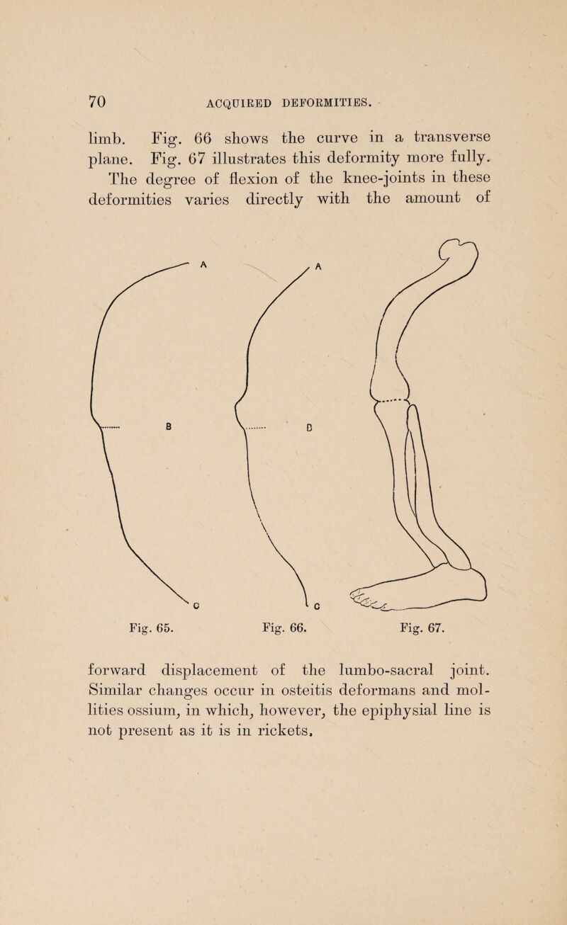 limb. Fig* 06 shows the curve in a transverse plane. Fig. 67 illustrates this deformity more fully. The degree of flexion of the knee-joints in these deformities varies directly with the amount of forward displacement of the bimbo-sacral joint. Similar changes occur in osteitis deformans and mol¬ lifies ossiurn, in which, however, the epiphysial line is not present as it is in rickets.