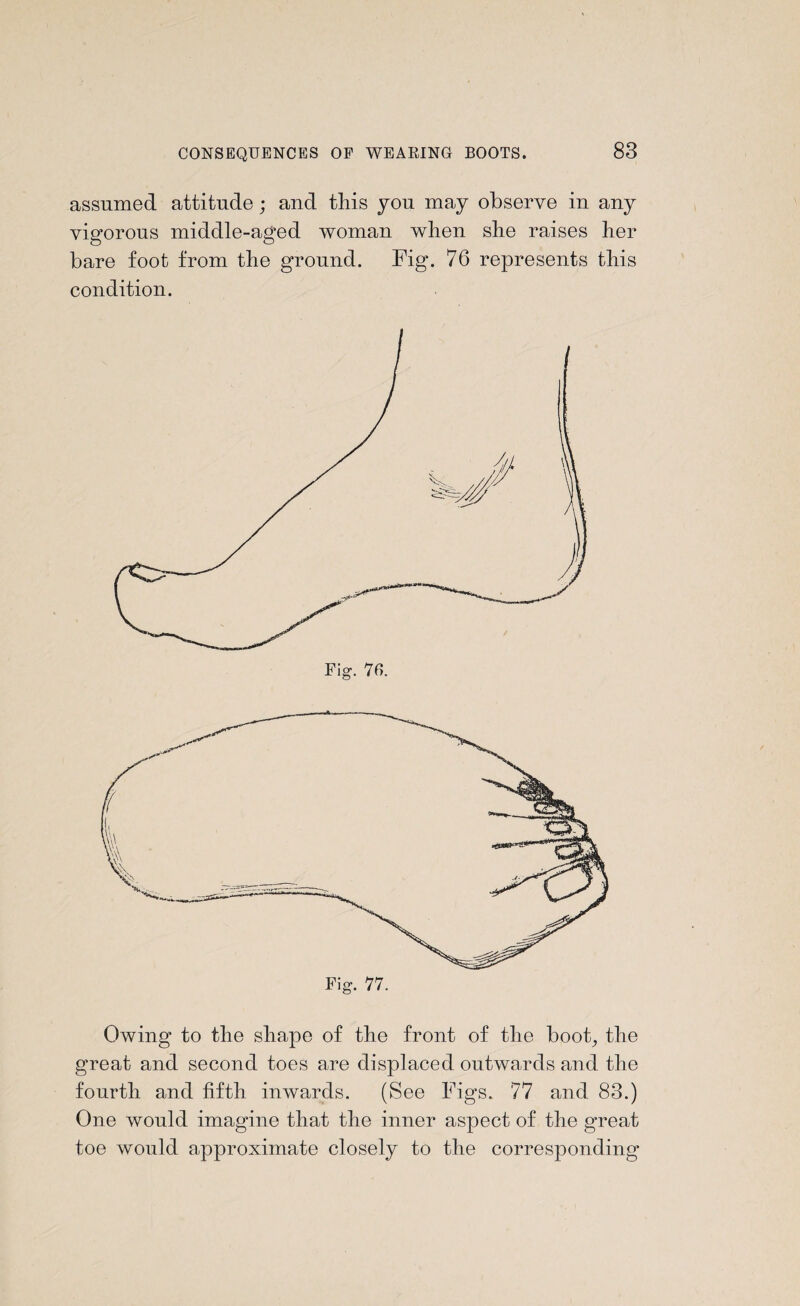 assumed attitude; and this you may observe in any vigorous middle-aged woman when she raises her bare foot from the ground. Fig. 76 represents this condition. Owing to the shape of the front of the boot, the great and second toes are displaced outwards and the fourth and fifth inwards. (See Figs. 77 and 83.) One would imagine that the inner aspect of the great toe would approximate closely to the corresponding