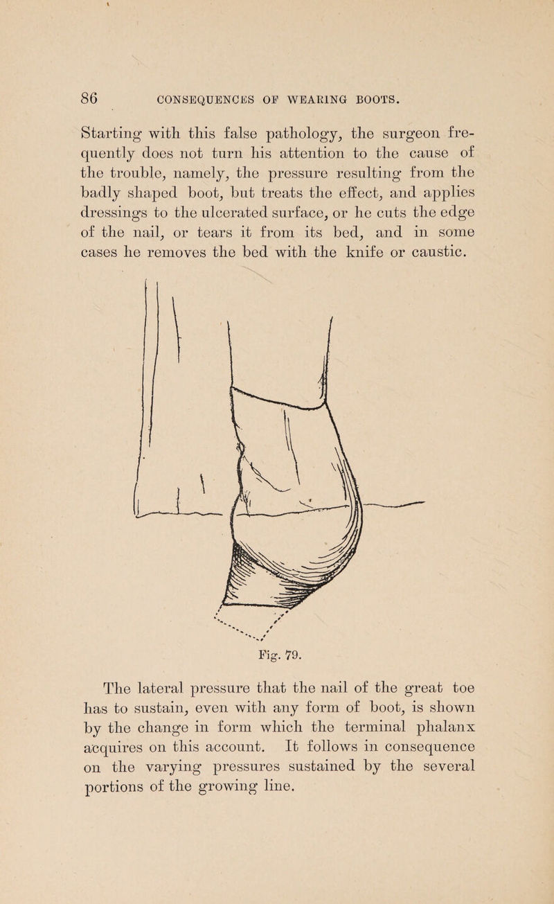 Starting with this false pathology, the surgeon fre¬ quently does not turn his attention to the cause of the trouble, namely, the pressure resulting from the badly shaped boot, but treats the effect, and applies dressings to the ulcerated surface, or he cuts the edge of the nail, or tears it from its bed, and in some cases he removes the bed with the knife or caustic. The lateral pressure that the nail of the great toe has to sustain, even with any form of boot, is shown by the change in form which the terminal phalanx acquires on this account. It follows in consequence on the varying pressures sustained by the several portions of the growing line.