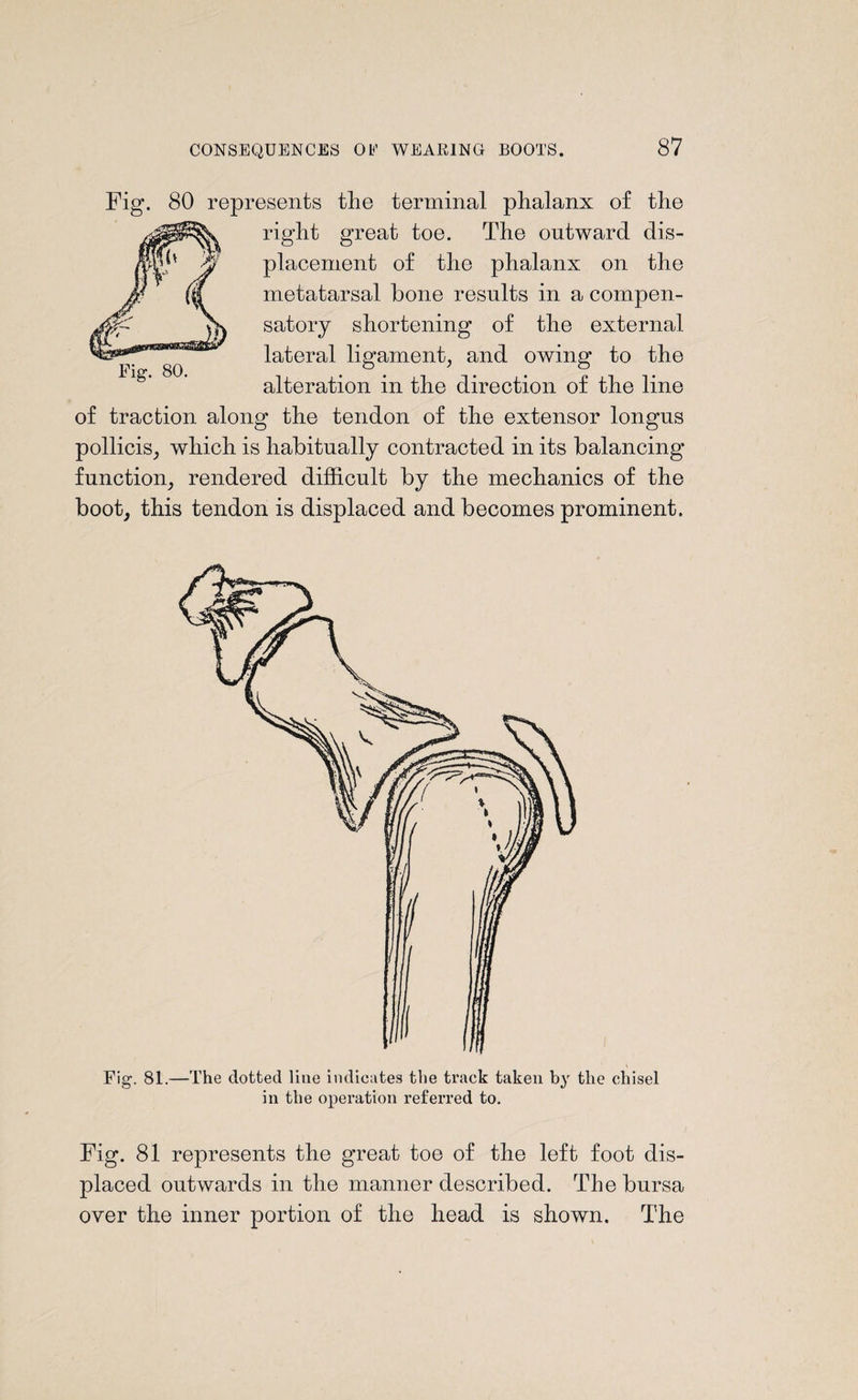 Fig. 80 represents the terminal phalanx of the right great toe. The outward dis¬ placement of the phalanx on the metatarsal bone results in a compen¬ satory shortening of the external lateral ligament, and owing to the alteration in the direction of the line of traction along the tendon of the extensor longns pollicis, which is habitually contracted in its balancing function, rendered difficult by the mechanics of the boot, this tendon is displaced and becomes prominent. Fig. 81.—The dotted Hue indicates the track taken by the chisel in the operation referred to. Fig. 81 represents the great toe of the left foot dis¬ placed outwards in the manner described. The bursa over the inner portion of the head is shown. The