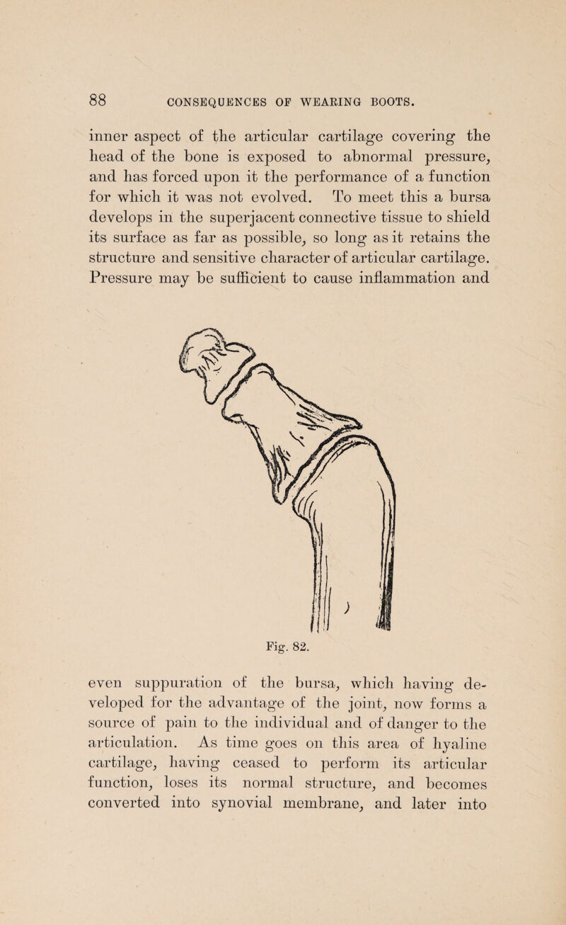 inner aspect of the articular cartilage covering the head of the bone is exposed to abnormal pressure, and has forced upon it the performance of a function for which it was not evolved. To meet this a bursa develops in the superjacent connective tissue to shield its surface as far as possible, so long as it retains the structure and sensitive character of articular cartilage. Pressure may be sufficient to cause inflammation and even suppuration of the bursa, which having de¬ veloped for the advantage of the joint, now forms a source of pain to the individual and of danger to the articulation. As time goes on this area of hyaline cartilage, having ceased to perform its articular function, loses its normal structure, and becomes converted into synovial membrane, and later into