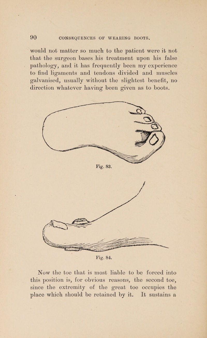 would not matter so much, to the patient were it not that the surgeon bases his treatment upon his false pathology, and it has frequently been my experience to find ligaments and tendons divided and muscles galvanised, usually without the slightest benefit, no direction whatever having' been given as to boots. / Now the toe that is most liable to be forced into this position is, for obvious reasons, the second toe, since the extremity of the great toe occupies the place which should be retained by it. It sustains a