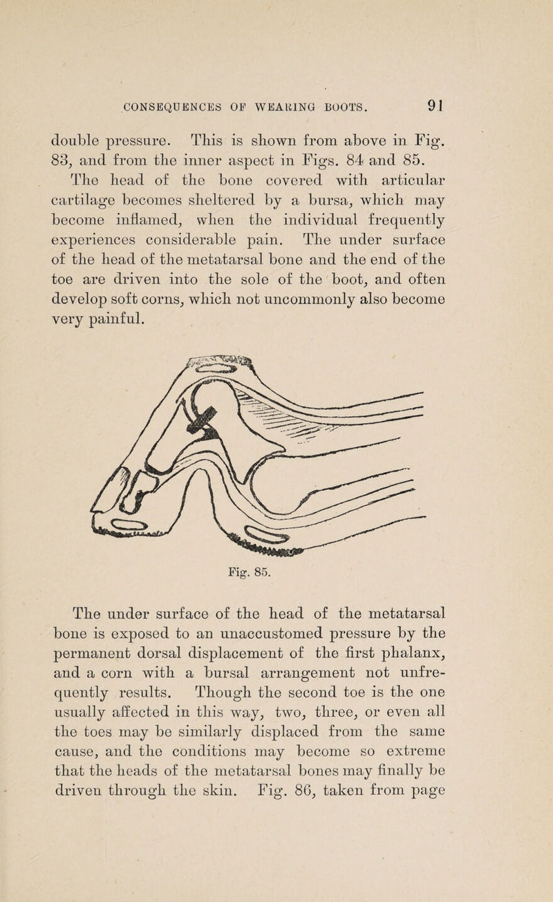 double pressure. This is shown from above in Fig. 83, and from the inner aspect in Figs. 84 and 85. The head of the bone covered with articular cartilage becomes sheltered by a bursa, which may become inflamed, when the individual frequently experiences considerable pain. The under surface of the head of the metatarsal bone and the end of the toe are driven into the sole of the boot, and often develop soft corns, which not uncommonly also become very painful. Fig. 85. The under surface of the head of the metatarsal bone is exposed to an unaccustomed pressure by the permanent dorsal displacement of the first phalanx, and a corn with a bursal arrangement not unfre- quently results. Though the second toe is the one usually affected in this way, two, three, or even all the toes may be similarly displaced from the same cause, and the conditions may become so extreme that the heads of the metatarsal bones may finally be driven through the skin. Fig. 86, taken from page