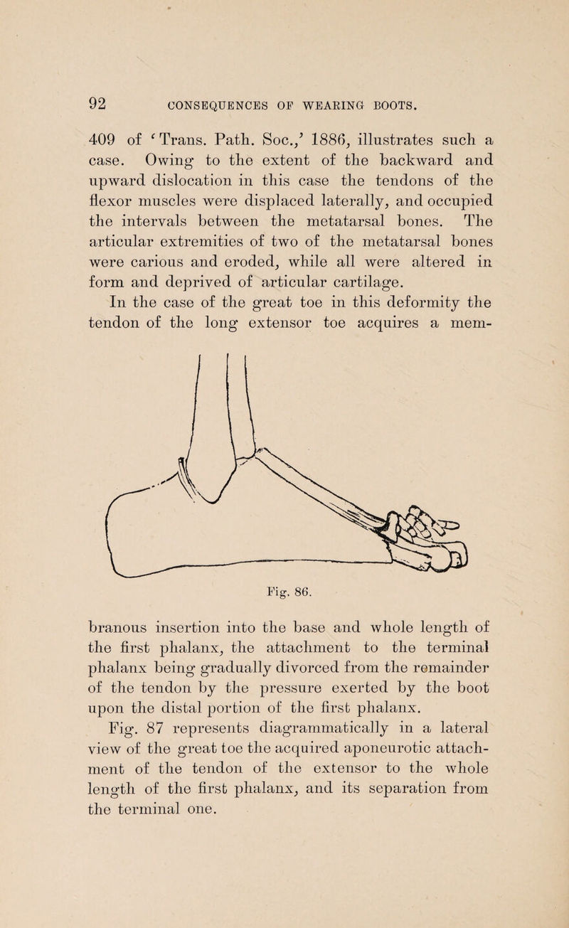 409 of f Trans. Path. Soc./ 1886, illustrates such a case. Owing to the extent of the backward and upward dislocation in this case the tendons of the flexor muscles were displaced laterally, and occupied the intervals between the metatarsal bones. The articular extremities of two of the metatarsal bones were carious and eroded, while all were altered in form and deprived of articular cartilage. In the case of the great toe in this deformity the tendon of the long extensor toe acquires a mem¬ branous insertion into the base and whole length of the first phalanx, the attachment to the terminal phalanx being gradually divorced from the remainder of the tendon by the pressure exerted by the boot upon the distal portion of the first phalanx. Fig. 87 represents diagrammatically in a lateral view of the great toe the acquired aponeurotic attach¬ ment of the tendon of the extensor to the whole length of the first phalanx, and its separation from the terminal one.