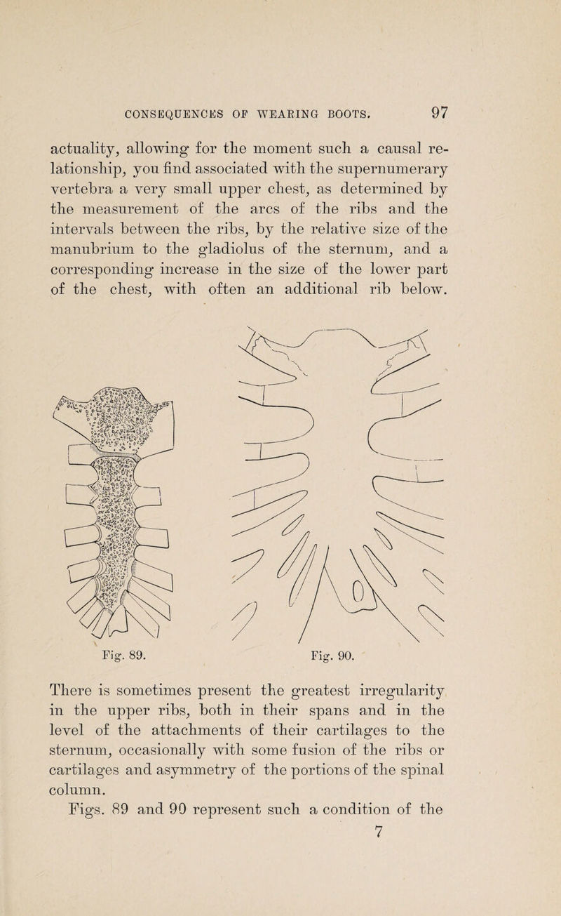 actuality, allowing for the moment such a causal re¬ lationship, you find associated with the supernumerary vertebra a very small upper chest, as determined by the measurement of the arcs of the ribs and the intervals between the ribs, by the relative size of the manubrium to the gladiolus of the sternum, and a corresponding increase in the size of the lower part of the chest, with often an additional rib below. There is sometimes present the greatest irregularity in the upper ribs, both in their spans and in the level of the attachments of their cartilages to the sternum, occasionally with some fusion of the ribs or cartilages and asymmetry of the portions of the spinal column. Figs. 89 and 90 represent such a condition of the 7