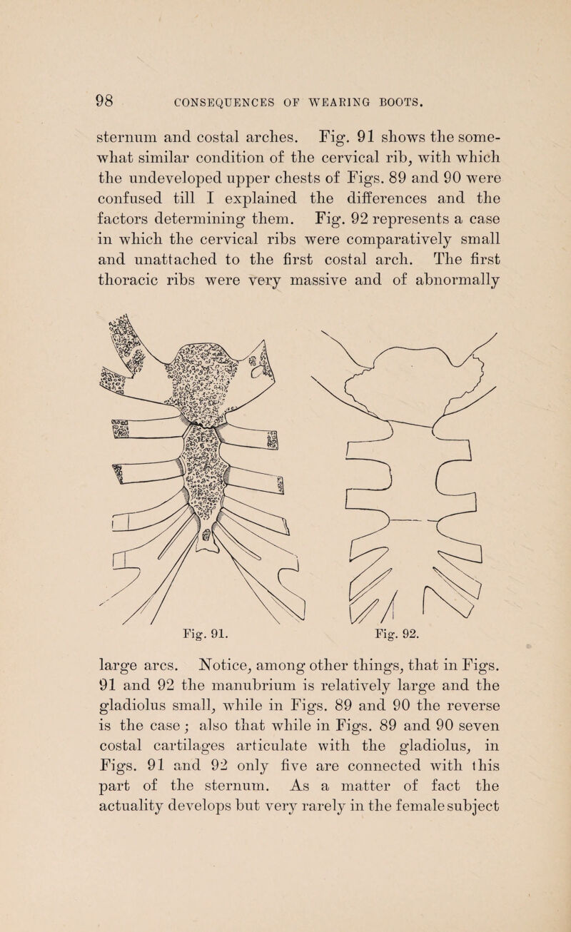sternum and costal arches. Fig. 91 shows the some¬ what similar condition of the cervical rib, with which the undeveloped upper chests of Figs. 89 and 90 were confused till I explained the differences and the factors determining them. Fig. 92 represents a case in which the cervical ribs were comparatively small and unattached to the first costal arch. The first thoracic ribs were very massive and of abnormally large arcs. Notice, among other things, that in Figs. 91 and 92 the manubrium is relatively large and the gladiolus small, while in Figs. 89 and 90 the reverse is the case; also that while in Figs. 89 and 90 seven costal cartilages articulate with the gladiolus, in Figs. 91 and 92 only five are connected with this part of the sternum. As a matter of fact the actuality develops but very rarely in the female subject