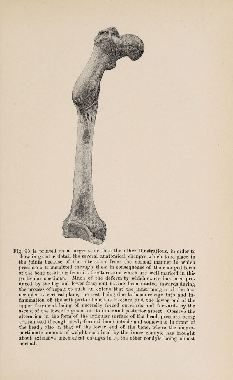 Fig. 93 is printed on a larger scale than the other illustrations, in order to show in greater detail the several anatomical changes which take place in the joints because of the alteration from the normal manner in which pressure is transmitted through them in consequence of the changed form of the bone resulting from its fracture, and which are well marked in this particular specimen. Much of the deformity which exists has been pro¬ duced by the leg and lower fragment having been rotated inwards during the process of repair to such an extent that the inner margin of the foot occupied a vertical plane, the rest being due to haemorrhage into and in¬ flammation of the soft parts about the fracture, and the lower end of the upper fragment being of necessity forced outwards and forwards by the ascent of the lower fragment on its inner and posterior aspect. Observe the alteration in the form of the articular surface of the head, pressure being transmitted through newly-formed bone outside and somewhat in front of the head; also in that of the lower end of the bone, where the dispro¬ portionate amount of weight sustained by the inner condyle has brought about extensive mechanical changes in it, the other condyle being almost normal.