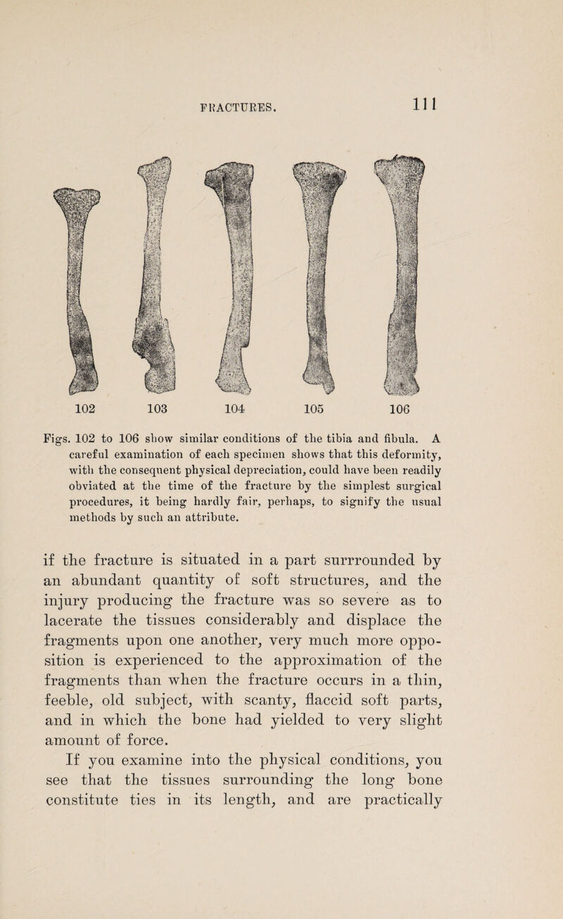 Hi 104 102 103 Figs. 102 to 106 show similar conditions of the tibia and fibula. A careful examination of each specimen shows that this deformity, with the consequent physical depreciation, could have been readily obviated at the time of the fracture by the simplest surgical procedures, it being hardly fair, perhaps, to signify the usual methods by such an attribute. 105 106 if the fracture is situated in a part surrrounded by an abundant quantity of soft structures, and the injury producing the fracture was so severe as to lacerate the tissues considerably and displace the fragments upon one another, very much more oppo¬ sition is experienced to the approximation of the fragments than when the fracture occurs in a thin, feeble, old subject, with scanty, flaccid soft parts, and in which the bone had yielded to very slight amount of force. If you examine into the physical conditions, you see that the tissues surrounding the long bone constitute ties in its length, and are practically