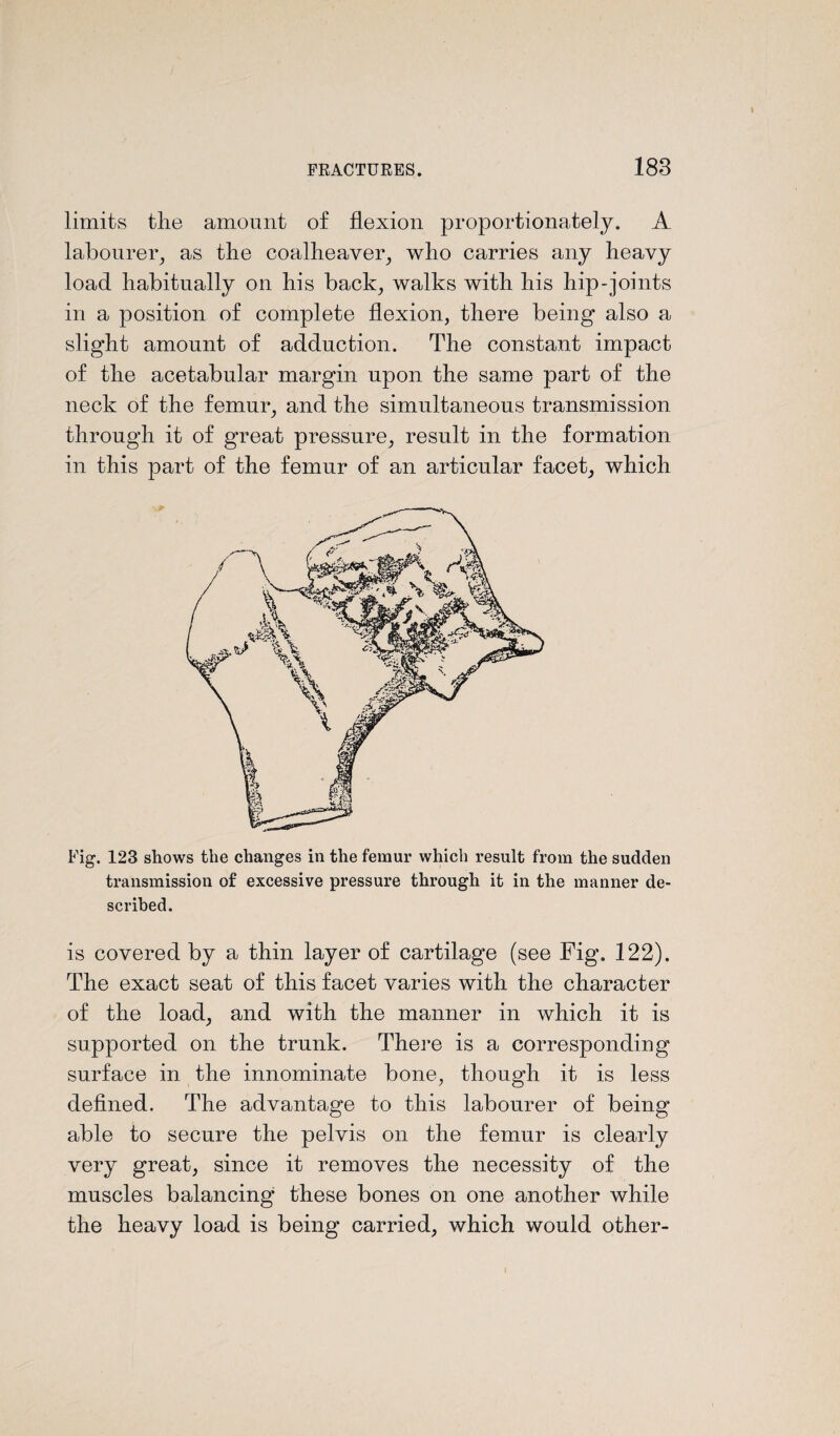 limits the amount of flexion proportionately. A labourer, as the coalheaver, who carries any heavy load habitually on his back, walks with his hip-joints in a position of complete flexion, there being also a slight amount of adduction. The constant impact of the acetabular margin upon the same part of the neck of the femur, and the simultaneous transmission through it of great pressure, result in the formation in this part of the femur of an articular facet, which Fig. 123 shows the changes in the femur which result from the sudden transmission of excessive pressure through it in the manner de¬ scribed. is covered by a thin layer of cartilage (see Fig. 122). The exact seat of this facet varies with the character of the load, and with the manner in which it is supported on the trunk. There is a corresponding surface in the innominate bone, though it is less defined. The advantage to this labourer of being able to secure the pelvis on the femur is clearly very great, since it removes the necessity of the muscles balancing these bones on one another while the heavy load is being carried, which would other-