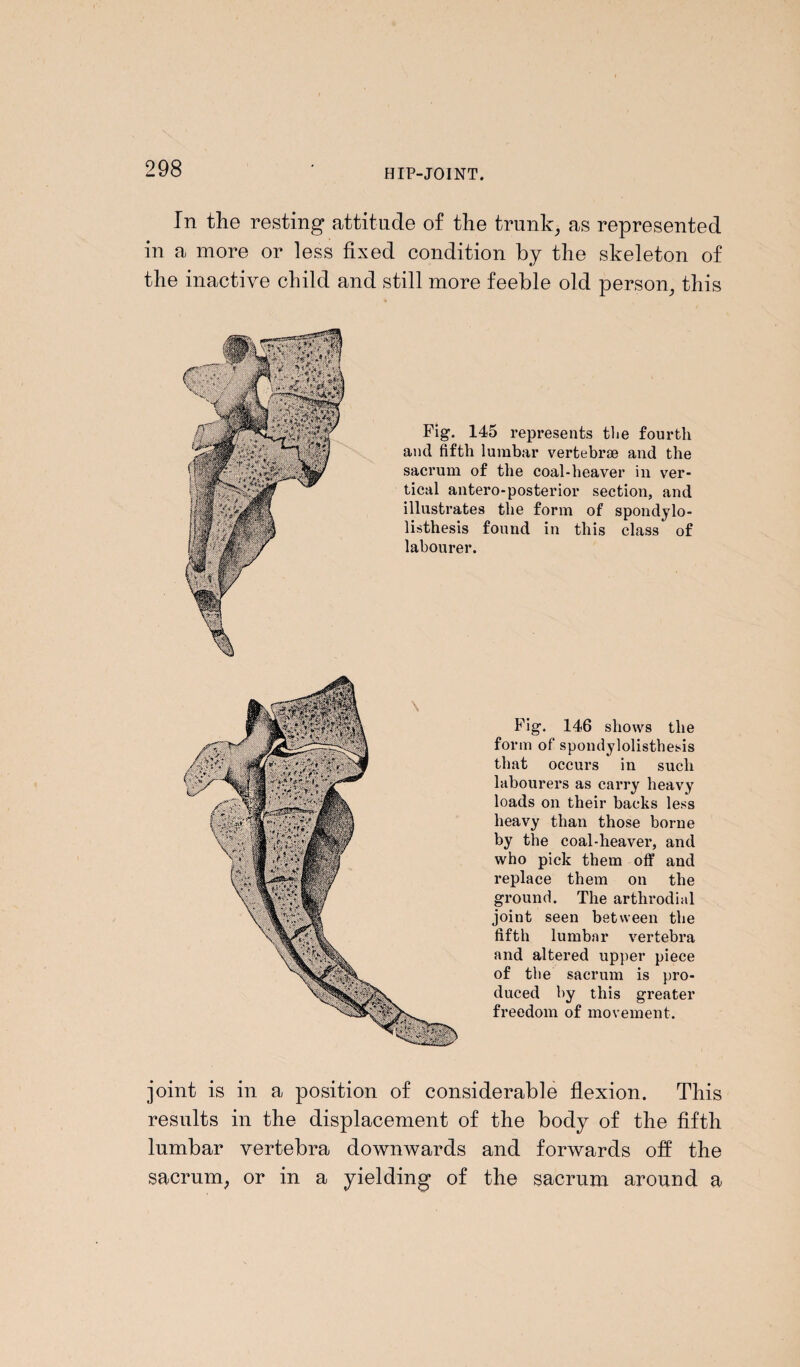 In the resting attitude of the trunk, as represented in a more or less fixed condition by the skeleton of the inactive child and still more feeble old person, this Fig. 145 represents the fourth and fifth lumbar vertebrae and the sacrum of the coal-heaver in ver¬ tical antero-posterior section, and illustrates the form of spondylo¬ listhesis found in this class of labourer. Fig. 146 shows the form of spondylolisthesis that occurs in such labourers as carry heavy loads on their hacks less heavy than those borne by the coal-heaver, and who pick them off and replace them on the ground. The arthrodial joint seen between the fifth lumbar vertebra and altered upper piece of the sacrum is pro¬ duced by this greater freedom of movement. joint is in a position of considerable flexion. This results in the displacement of the body of the fifth lumbar vertebra downwards and forwards off the sacrum, or in a yielding of the sacrum around a