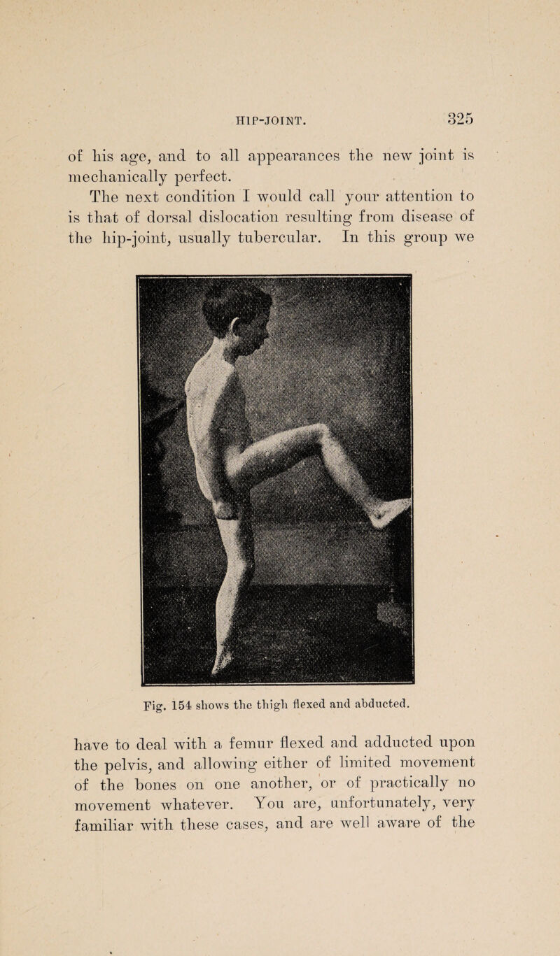 of liis age, and to all appearances the new joint is mechanically perfect. The next condition I would call your attention to is that of dorsal dislocation resulting from disease of the hip-joint, usually tubercular. In this group we Fig. 154 shows the thigh flexed and abducted. have to deal with a femur flexed and adducted upon the pelvis, and allowing either of limited movement of the bones on one another, or of practically no movement whatever. You are, unfortunately, very familiar with these cases, and are well aware of the