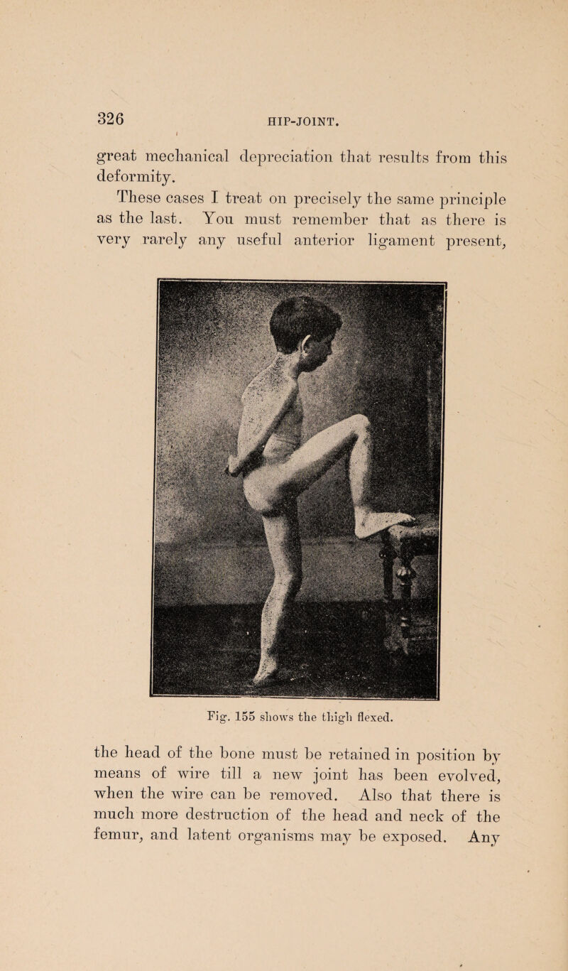 great mechanical depreciation that results from this deformity. These cases I treat on precisely the same principle as the last. You must remember that as there is very rarely any useful anterior ligament present. Fig-. 155 shows the thigh flexed. the head of the bone must be retained in position by means of wire till a new joint has been evolved, when the wire can be removed. Also that there is much more destruction of the head and neck of the femur, and latent organisms may be exposed. Any