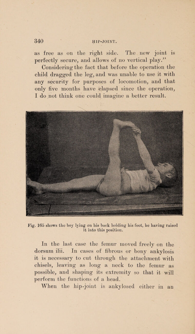 as free as on the right side. The new joint is perfectly secure, and allows of no vertical play.” Considering the fact that before the operation the child dragged the leg, and was unable to use it with any security for purposes of locomotion, and that only five months have elapsed since the operation, I do not think one could imagine a better result. Fig. 165 shows the boy lying on his back holding his foot, he having raised it into this position. In the last case the femur moved freely on the dorsum ilii. In cases of fibrous or bony ankylosis it is necessary to cut through the attachment with chisels, leaving as long a neck to the femur as possible, and shaping its extremity so that it will perform the functions of a head., When the hip-joint is ankylosed either in an