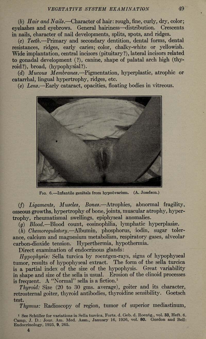 (6) Hair and Nails.—Character of hair: rough, fine, curly, dry, color; eyelashes and eyebrows. General hairiness—distribution. Crescents in nails, character of nail developments, splits, spots, and ridges. (c) Teeth.—Primary and secondary dentition, dental forms, dental resistances, ridges, early caries; color, chalky-white or yellowish. Wide implantation, central incisors (pituitary?), lateral incisors related to gonadal development (?), canine, shape of palatal arch high (thy¬ roid?), broad, (hypophysial?). (id) Mucous Membranes.—Pigmentation, hyperplastic, atrophic or catarrhal, lingual hypertrophy, ridges, etc. (e) Lens.—Early cataract, opacities, floating bodies in vitreous. Fig. 6.—Infantile genitals from hypoovarism. (A. Josef son.) (f) Ligaments, Muscles, Bones.—Atrophies, abnormal fragility, osseous growths, hypertrophy of bone, joints, muscular atrophy, hyper¬ trophy, rheumatismal swellings, epiphyseal anomalies. (g) Blood.—Blood count, eosinophilia, lymphatic hyperplasise. (h) Chemoregulatory.—Albumin, phosphorus, iodin, sugar toler¬ ance, calcium and magnesium metabolism, respiratory gases, alveolar carbon-dioxide tension. Hyperthermia, hypothermia. Direct examination of endocrinous glands: Hypophysis: Sella turcica by roentgen-rays, signs of hypophyseal tumor, results of hypophyseal extract. The form of the sella turcica is a partial index of the size of the hypophysis. Great variability in shape and size of the sella is usual. Erosion of the clinoid processes is frequent. A “Normal” sella is a fiction.1 * * 4 Thyroid: Size (20 to 30 gms. average), goiter and its character, retrosternal goiter, thyroid antibodies, thyroidine sensibility. Goetsch test. . Thymus: Radioscopy of region, tumor of superior mediastinum, 1 See Schuller for variations in Sella turcica, Forts, d. Geb. d. Roentg., vol. 33, Heft, 6. Camp, J. D.: Jour. Am. Med. Assn., January 16, 1926, vol. 80. Gordon and Bell: Endocrinology, 1925, 9, 265. 4