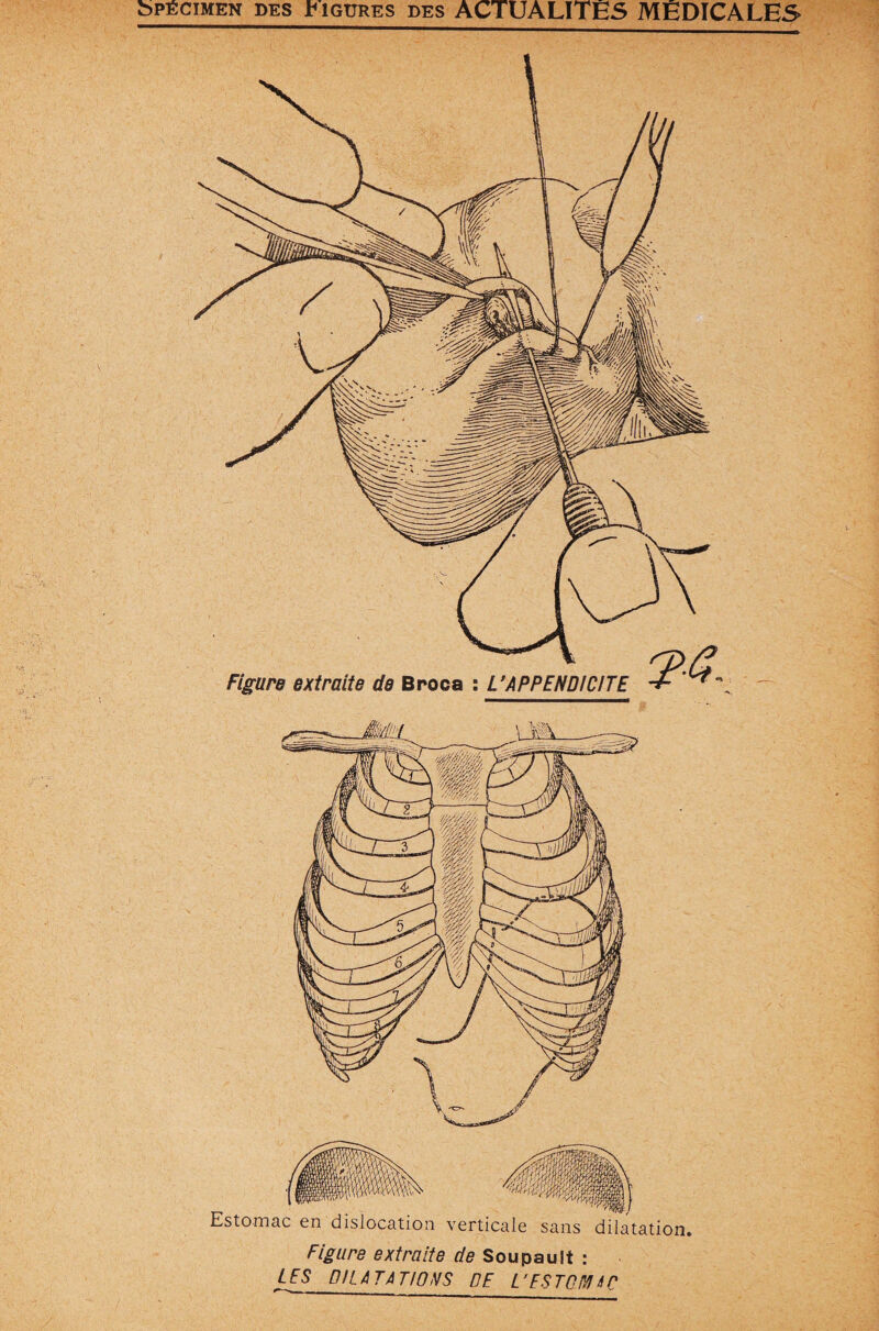 Figure extraite de Broca : L’APPENDICITE Estomac en dislocation verticale sans dilatation. Figure extraite de Soupault : LES DILATATIONS DE L’ESTOAA tC