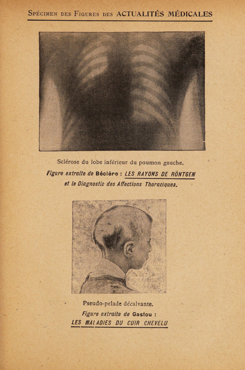 Sclérose du lobe inférieur du poumon gauche. Figure extraite de Béclèro : LES RAYONS DE R ONT GEN et le Diagnostic des A ffections Thoraciques. Pseudo-pelade décalvante. Figure extraite de Gastou : LES MALADIES DU CUIR CHEVELU