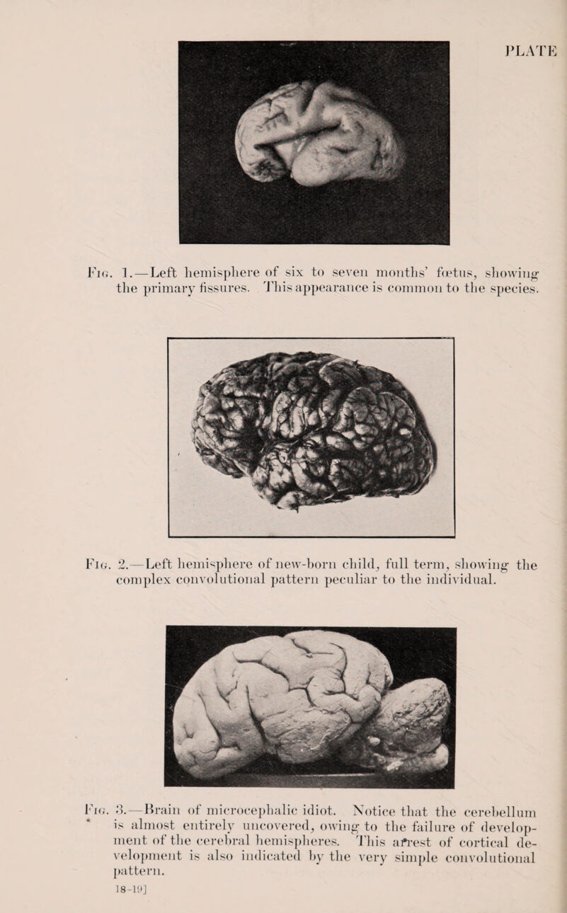 PLATE Fig. 1.—Left hemisphere of six to seven months’ fietus, showing the primary fissures. This appearance is common to the species. Fig. 2.— Left hemisphere of new-born child; full term, showing the complex convolutional pattern peculiar to the individual. Fig. 3.—Brain of microcephalic idiot. Notice that the cerebellum is almost entirely uncovered; owing to the failure of develop¬ ment of the cerebral hemispheres. This afrest of cortical de¬ velopment is also indicated by the very simple convolutional pattern. 18-19]