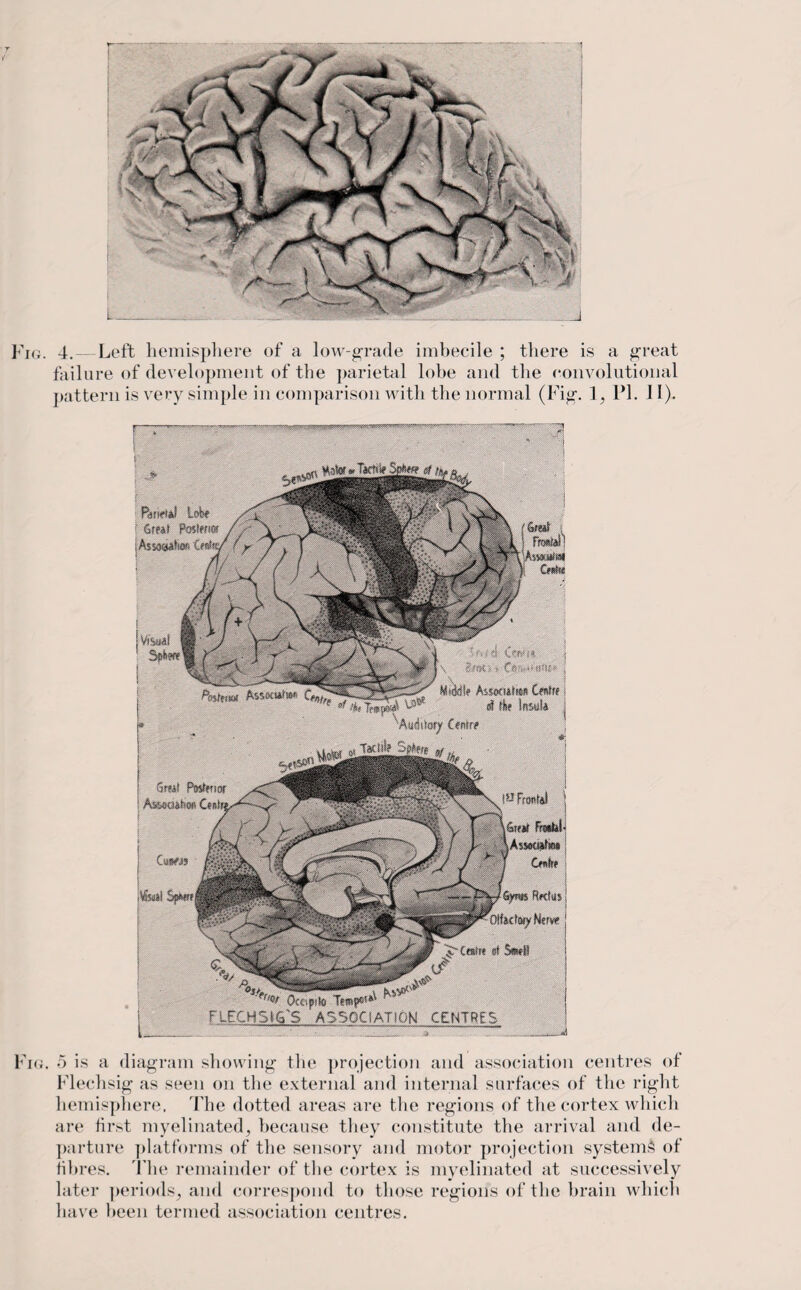 Fig. 4. — Left hemisphere of a low-grade imbecile ; there is a great failure of development of the parietal lobe and the convolutional pattern is very simple in comparison with the normal (Fig. I, PI. II). Grfi! PoVffiof Asiooihon Gai Kwn }» Zew’w* hsmilm Cmtu j lie k«ls j Frontal Grew Fretfc! .Mtahoa Owlfe I | Sym flecks | Otfscfoey Nerve 1 Coot st Seseil i '***&. Ocapite FLECHSMa'S ASSOCIATION CENTRES Fig. 5 is a diagram showing the projection and association centres of Flechsig as seen on the external and internal surfaces of the right hemisphere. The dotted areas are the regions of the cortex which are first myelinated, because they constitute the arrival and de¬ parture platforms of the sensory and motor projection systems of fibres. The remainder of the cortex is myelinated at successively later periods, and correspond to those region's of the brain which have been termed association centres.