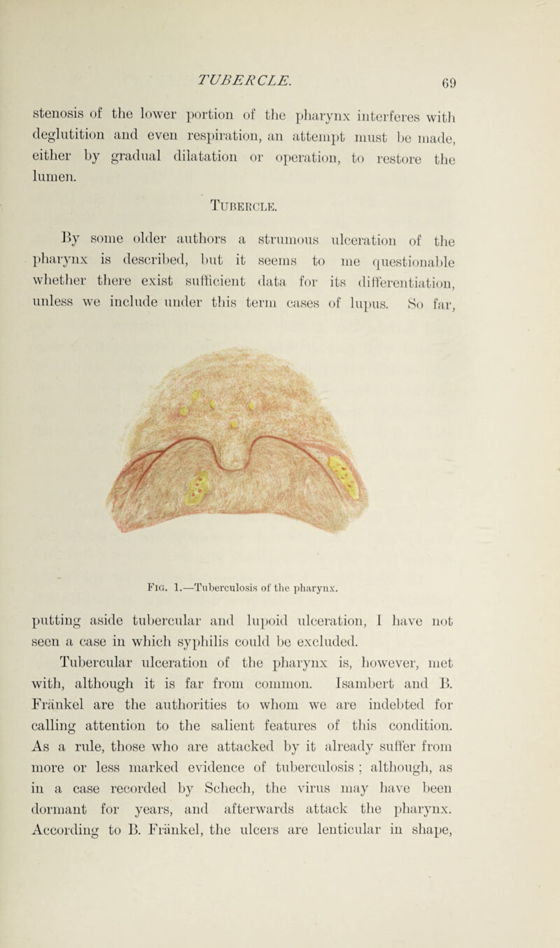 stenosis of the lower portion of the pharynx interferes with deglutition and even respiration, an attempt must be made, either by gradual dilatation or operation, to restore the lumen. Tubercle. By some older authors a strumous ulceration of the pharynx is described, but it seems to me questionable whether there exist sufficient data for its differentiation, unless we include under this term cases of lupus. So far, Fig. 1.—Tuberculosis of the pharynx. putting aside tubercular and lupoid ulceration, 1 have not seen a case in which syphilis could be excluded. Tubercular ulceration of the pharynx is, however, met with, although it is far from common. Isambert and B. Frankel are the authorities to whom we are indebted for calling attention to the salient features of this condition. As a rule, those who are attacked by it already suffer from more or less marked evidence of tuberculosis ; although, as in a case recorded by Schech, the virus may have been dormant for years, and afterwards attack the pharynx. According to B. Frankel, the ulcers are lenticular in shape,