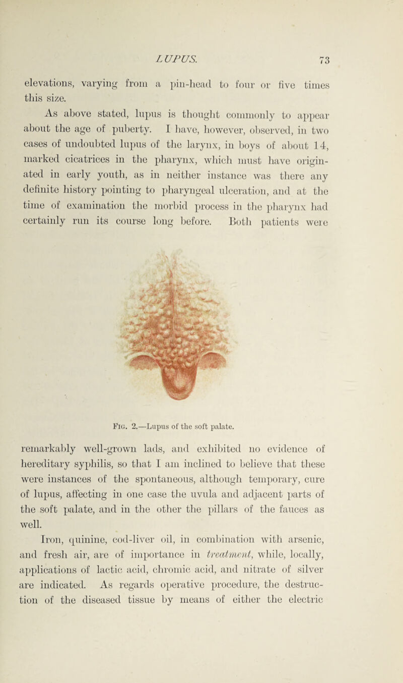 elevations, varying from a pin-head to four or live times this size. As above stated, lupus is thought commonly to appear about the age of puberty. I have, however, observed, in two cases of undoubted lupus of the larynx, in boys of about 14, marked cicatrices in the pharynx, which must have origin¬ ated in early youth, as in neither instance was there any definite history pointing to pharyngeal ulceration, and at the time of examination the morbid process in the pharynx had certainly run its course long before. Both patients were Fig. 2.—Lupus of the soft palate. remarkably well-grown lads, and exhibited no evidence of hereditary syphilis, so that I am inclined to believe that these were instances of the spontaneous, although temporary, cure of lupus, affecting in one case the uvula and adjacent parts of the soft palate, and in the other the pillars of the fauces as well. Iron, quinine, cod-liver oil, in combination with arsenic, and fresh air, are of importance in treatment, while, locally, applications of lactic acid, chromic acid, and nitrate of silver are indicated. As regards operative procedure, the destruc¬ tion of the diseased tissue by means of either the electric