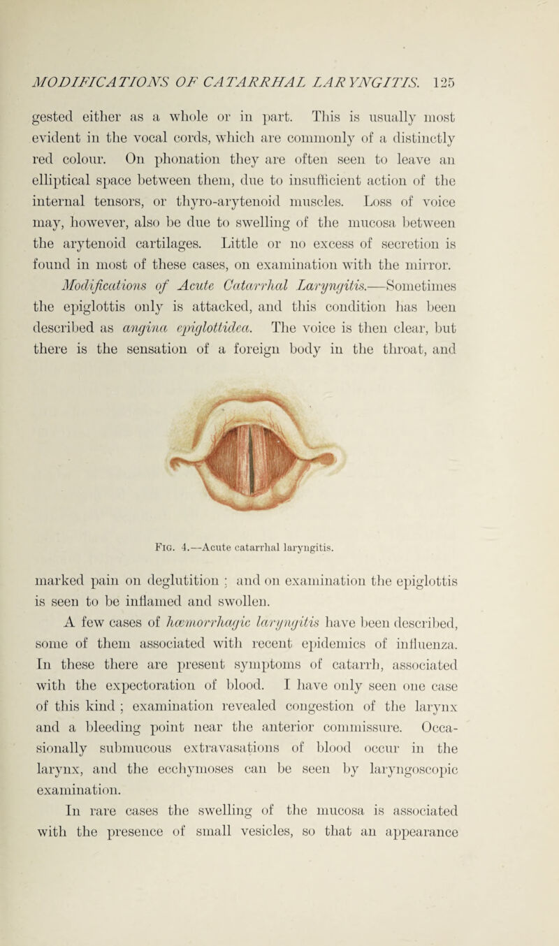 gested either as a whole or in part. This is usually most evident in the vocal cords, which are commonly of a distinctly red colour. On phonation they are often seen to leave an elliptical space between them, due to insufficient action of the internal tensors, or thyro-arytenoid muscles. Loss of voice may, however, also be due to swelling of the mucosa between the arytenoid cartilages. Little or no excess of secretion is found in most of these cases, on examination with the mirror. Modifications of Acute Catarrhal Laryngitis.—Sometimes the epiglottis only is attacked, and this condition has been described as angina cpiglottidca. The voice is then clear, but there is the sensation of a foreign body in the throat, and Fig. 4.—Acute catarrhal laryngitis. marked pain on deglutition ; and on examination the epiglottis is seen to be inflamed and swollen. A few cases of haemorrhagic laryngitis have been described, some of them associated with recent epidemics of influenza. In these there are present symptoms of catarrh, associated with the expectoration of blood. I have only seen one case of this kind ; examination revealed congestion of the larynx and a bleeding point near the anterior commissure. Occa¬ sionally submucous extravasations of blood occur in the larynx, and the ecchymoses can be seen by laryngoscopic examination. In rare cases the swelling of the mucosa is associated with the presence of small vesicles, so that an appearance