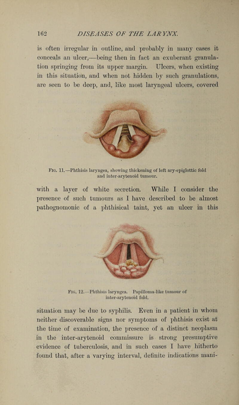 is often irregular in outline, and probably in many cases it conceals an ulcer,—being then in fact an exuberant granula¬ tion springing from its upper margin. Ulcers, when existing in this situation, and when not hidden by such granulations, are seen to be deep, and, like most laryngeal ulcers, covered Fig. 11.—Phthisis laryngea, showing thickening ofleft ary-epiglottic fold and inter-arytenoid tumour. with a layer of white secretion. While I consider the presence of such tumours as I have described to be almost pathognomonic of a phthisical taint, yet an ulcer in this Fig. 12.—Phthisis laryngea. Papilloma-like tumour of inter-arytenoid fold. situation may be due to syphilis. Even in a patient in whom neither discoverable signs nor symptoms of phthisis exist at the time of examination, the presence of a distinct neoplasm in the inter-arytenoid commissure is strong presumptive evidence of tuberculosis, and in such cases I have hitherto found that, after a varying interval, definite indications mani-