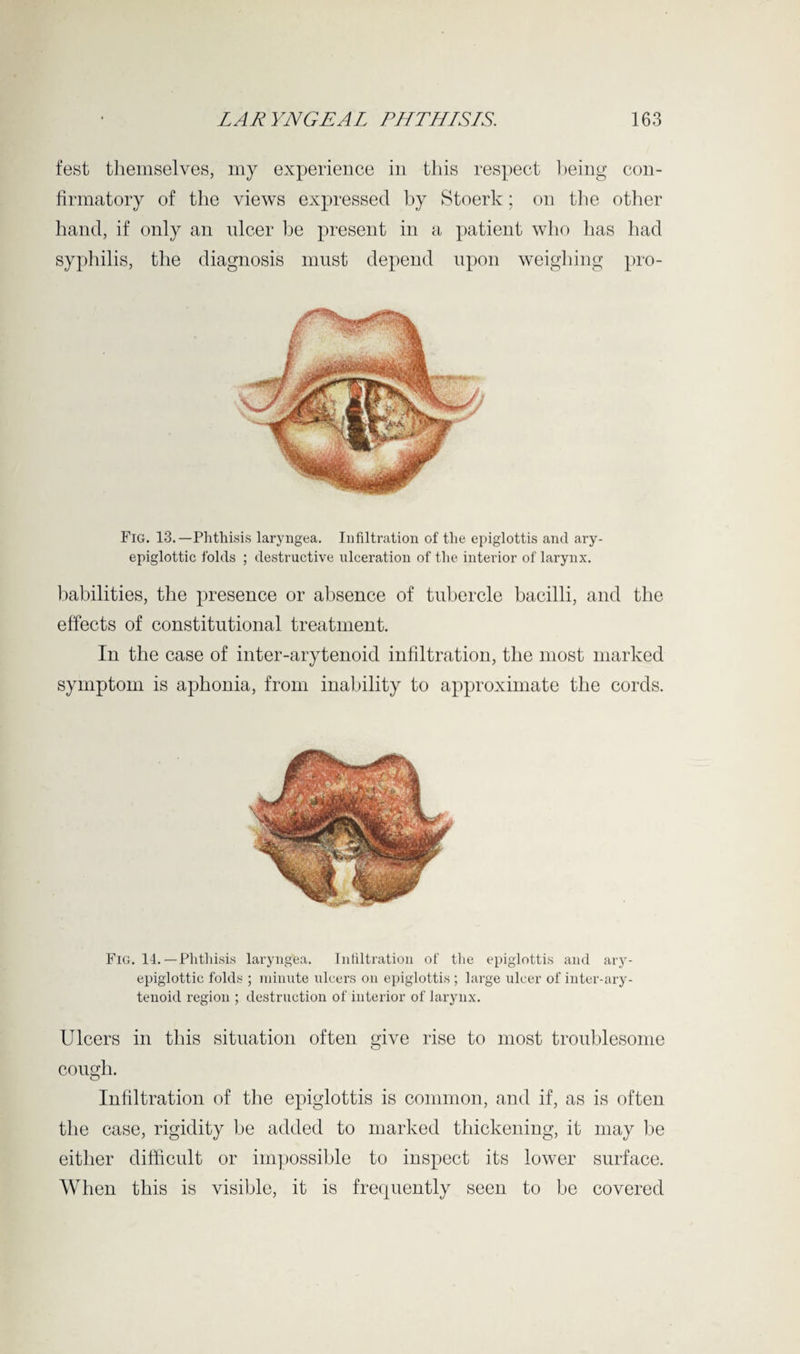 fest themselves, my experience in this respect being con¬ firmatory of the views expressed by Stoerk; on the other hand, if only an nicer be present in a patient who has had syphilis, the diagnosis must depend upon weighing pro- Fig. 13.—Phthisis laryngea. Infiltration of the epiglottis and ary- epiglottic folds ; destructive ulceration of the interior of larynx. liabilities, the presence or absence of tubercle bacilli, and the effects of constitutional treatment. In the case of inter-arytenoid infiltration, the most marked symptom is aphonia, from inability to approximate the cords. Fig. 14.—Phthisis laryngea. Infiltration of the epiglottis and ary- epiglottic folds ; minute ulcers on epiglottis ; large ulcer of inter-ary¬ tenoid region ; destruction of interior of larynx. Ulcers in this situation often give rise to most troublesome cough. Infiltration of the epiglottis is common, and if, as is often the case, rigidity be added to marked thickening, it may be either difficult or impossible to inspect its lower surface. When this is visible, it is frequently seen to be covered