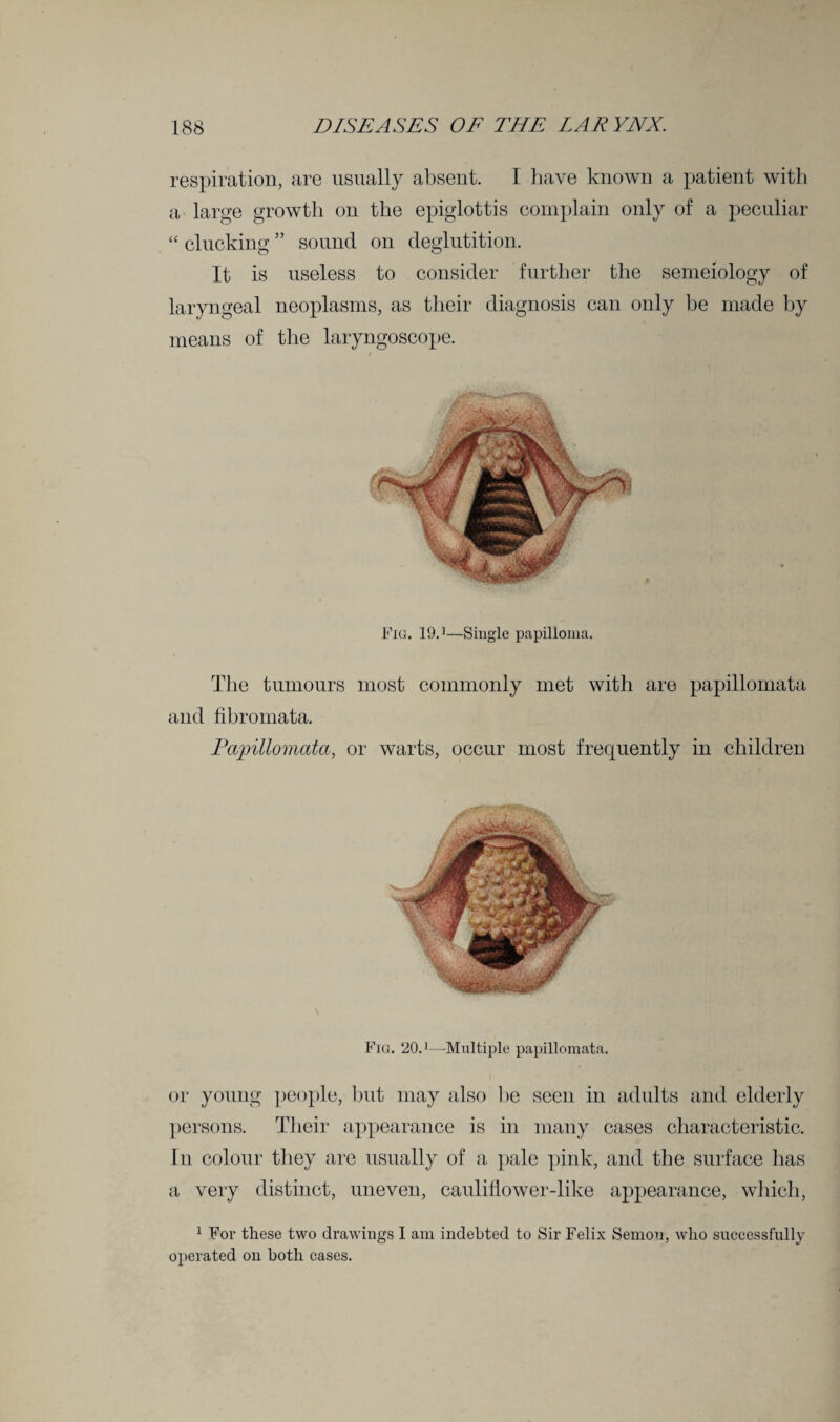 respiration, are usually absent. I have known a patient with a large growth on the epiglottis complain only of a peculiar “ clucking ” sound on deglutition. It is useless to consider further the semeiology of laryngeal neoplasms, as their diagnosis can only be made by means of the laryngoscope. Fig. 19.1—Single papilloma. The tumours most commonly met with are papillomata and fibromata. Papillomata, or warts, occur most frequently in children Fig. 20. j—Multiple papillomata. or young people, but may also be seen in adults and elderly persons. Their appearance is in many cases characteristic. In colour they are usually of a pale pink, and the surface has a very distinct, uneven, cauliflower-like appearance, which, 1 For these two drawings I am indebted to Sir Felix Semon, who successfully operated on both cases.