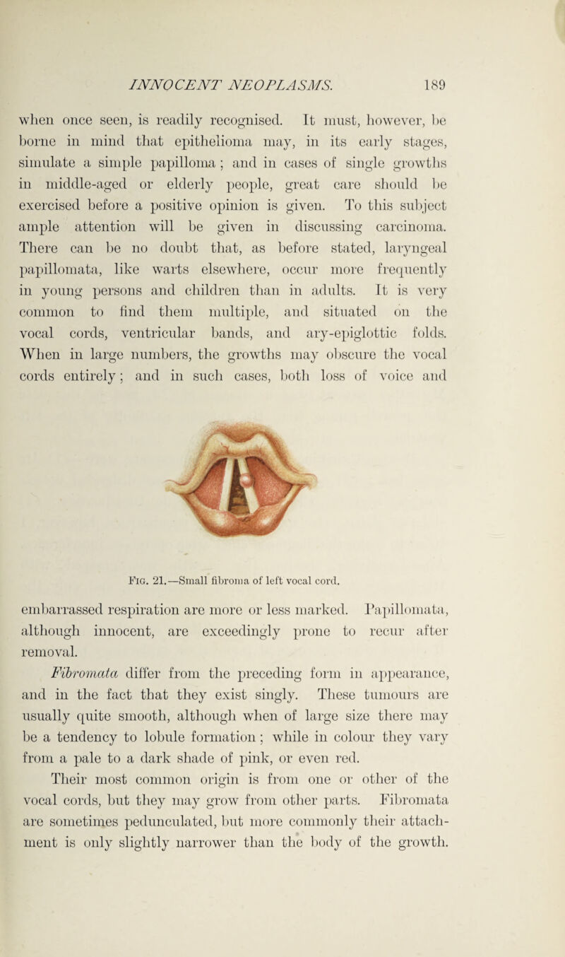 when once seen, is readily recognised. It must, however, he borne in mind that epithelioma may, in its early stages, simulate a simple papilloma ; and in cases of single growths in middle-aged or elderly people, great care should he exercised before a positive opinion is given. To this subject ample attention will be given in discussing carcinoma. There can be no doubt that, as before stated, laryngeal papillomata, like warts elsewhere, occur more frequently in young persons and children than in adults. It is very common to find them multiple, and situated on the vocal cords, ventricular bands, and ary-epiglottic folds. When in large numbers, the growths may obscure the vocal cords entirely; and in such cases, both loss of voice and Fig. 21.—Small fibroma of left vocal cord. embarrassed respiration are more or less marked. Papillomata, although innocent, are exceedingly prone to recur after removal. Fibromata differ from the preceding form in appearance, and in the fact that they exist singly. These tumours are usually quite smooth, although when of large size there may be a tendency to lobule formation; while in colour they vary from a pale to a dark shade of pink, or even red. Their most common origin is from one or other of the vocal cords, but they may grow from other parts. Fibromata are sometimes pedunculated, hut more commonly their attach¬ ment is only slightly narrower than the body of the growth.