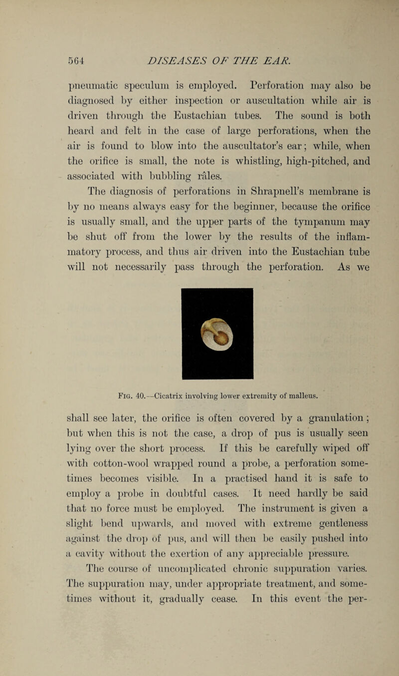 pneumatic speculum is employed. Perforation may also be diagnosed by either inspection or auscultation while air is driven through the Eustachian tubes. The sound is both heard and felt in the case of large perforations, when the air is found to blow into the auscultator’s ear; while, when the orifice is small, the note is whistling, high-pitched, and associated with bubbling rales. The diagnosis of perforations in Shrapnell’s membrane is by no means always easy for the beginner, because the orifice is usually small, and the upper parts of the tympanum may be shut off from the lower by the results of the inflam¬ matory process, and thus air driven into the Eustachian tube will not necessarily pass through the perforation. As we Fig. 40.—Cicatrix involving lower extremity of malleus. shall see later, the orifice is often covered by a granulation ; but when this is not the case, a drop of pus is usually seen lying over the short process. If this be carefully wiped off with cotton-wool wrapped round a probe, a perforation some¬ times becomes visible. In a practised hand it is safe to employ a probe in doubtful cases. It need hardly be said that no force must be employed. The instrument is given a slight bend upwards, and moved witli extreme gentleness against the drop of pus, and will then be easily pushed into a cavity without the exertion of any appreciable pressure. The course of uncomplicated chronic suppuration varies. The suppuration may, under appropriate treatment, and some¬ times without it, gradually cease. In this event the per-