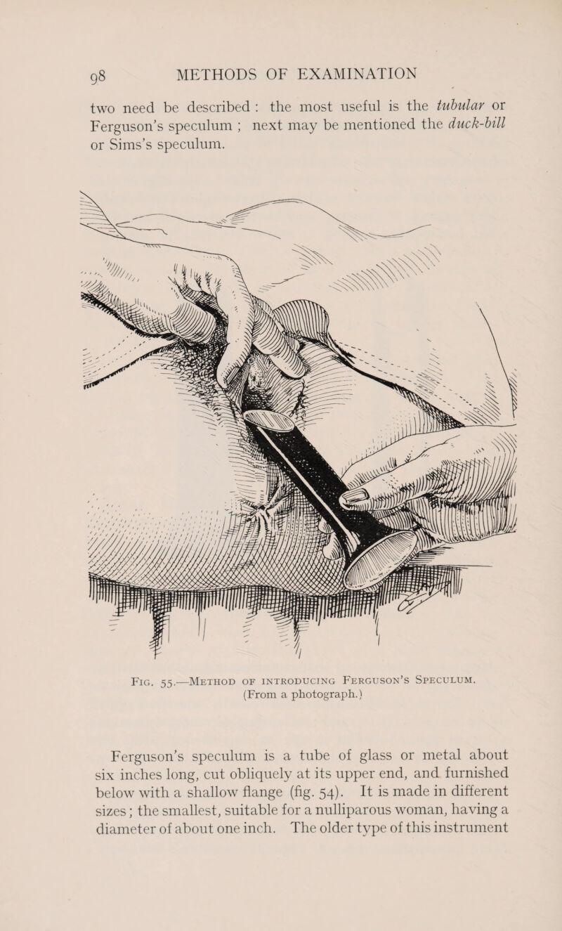 two need be described : the most useful is the tubular or Ferguson's speculum ; next may be mentioned the duck-bill or Sims’s speculum. Fig. 55.—Method of introducing Ferguson’s Speculum. (From a photograph.) Ferguson’s speculum is a tube of glass or metal about six inches long, cut obliquely at its upper end, and furnished below with a shallow flange (fig. 54). It is made in different sizes; the smallest, suitable for a nulliparous woman, having a diameter of about one inch. The older type of this instrument