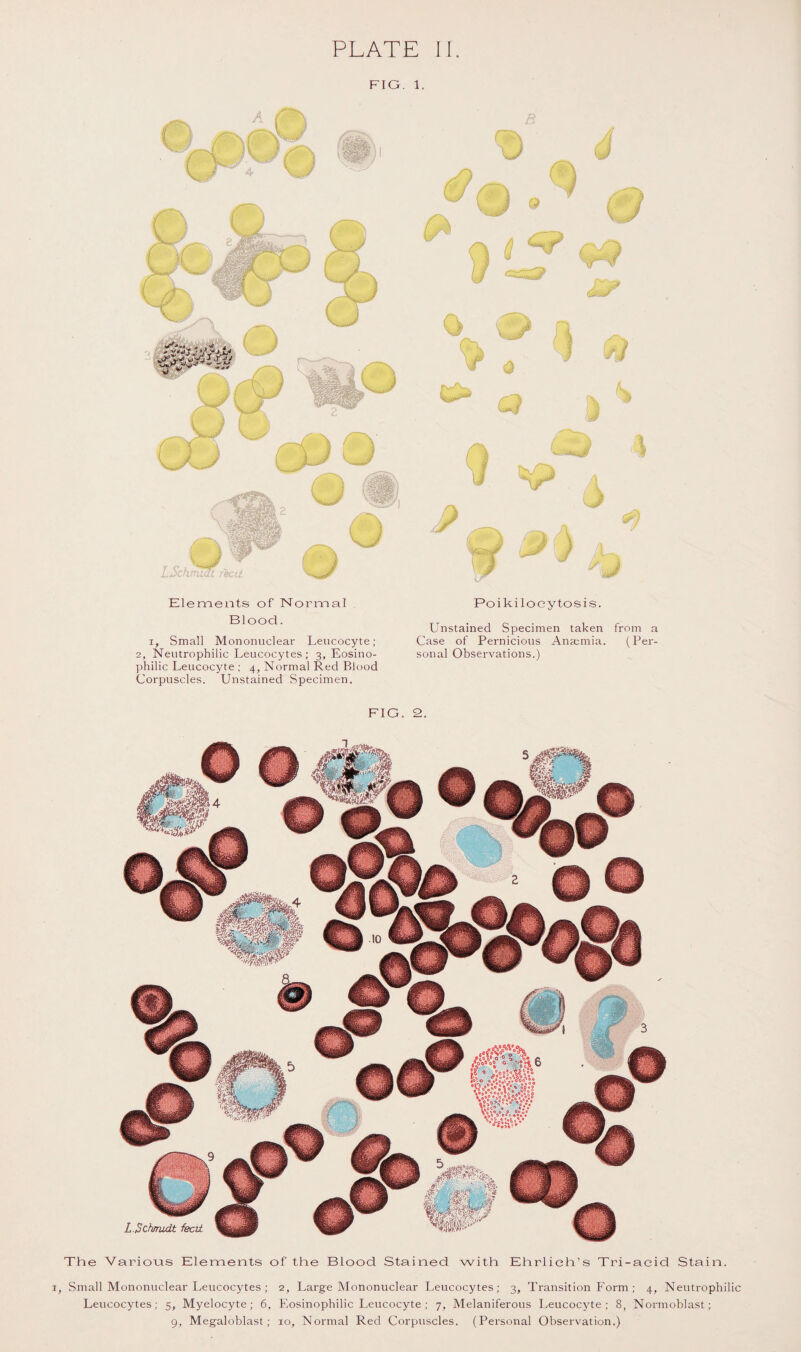 FIG. 1. Elements of Normal Blood. i, Small Mononuclear Leucocyte; 2, Neutrophilic Leucocytes; 3, Eosino¬ philic Leucocyte ; 4, Normal Red Blood Corpuscles. Unstained Specimen. Poikiloeytosis. Unstained Specimen taken from a Case of Pernicious Anaemia. (Per¬ sonal Observations.) FIG. 2. L . Schmidt feed. The Various Elements of the Blood Stained with Ehrlich’s Tri-aeid Stain. , Small Mononuclear Leucocytes ; 2, Large Mononuclear Leucocytes; 3, Transition Form ; 4, Neutrophilic Leucocytes; 5, Myelocyte; 6. Eosinophilic Leucocyte ; 7, Melaniferous Leucocyte; 8, Normoblast; 9, Megaloblast; 10, Normal Red Corpuscles. (Personal Observation.)