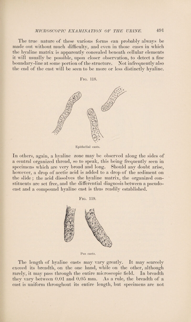 The true nature of these various forms can probably always be made out without much difficulty, and even in those cases in which the hyaline matrix is apparently concealed beneath cellular elements it will usually be possible, upon closer observation, to detect a fine boundary-line at some portion of the structure. Not infrequently also the end of the cast will be seen to be more or less distinctly hyaline. Ftg. 118. In others, again, a hyaline zone may be observed along the sides of a central organized thread, so to speak, this being frequently seen in specimens which are very broad and long. Should any doubt arise, however, a drop of acetic acid is added to a drop of the sediment on the slide ; the acid dissolves the hyaline matrix, the organized con¬ stituents are set free, and the differential diagnosis between a pseudo¬ cast and a compound hyaline cast is thus readily established. Fig. 119. Pus easts. The length of hyaline casts may vary greatly. It may scarcely exceed its breadth, on the one hand, while on the other, although rarely, it may pass through the entire microscopic field. In breadth they vary between 0.01 and 0.05 mm. As a rule, the breadth of a cast is uniform throughout its entire length, but specimens are not