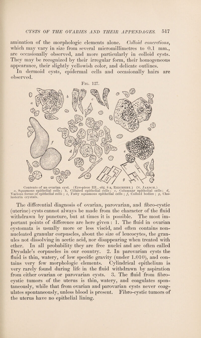 animation of the morphologic elements alone. Colloid concretions, which may vary in size from several micromillimetres to 0.1 mm., are occasionally observed, and more particularly in colloid cysts. They may be recognized by their irregular form, their homogeneous appearance, their slightly yellowish color, and delicate outlines. In dermoid cysts, epidermal cells and occasionally hairs are observed. Fig. 127. Contents of an ovarian cyst. (Eye-piece III., obj. 8 a, Reichert.) (v. Jaksch.) a, Squamous epithelial cells ; b, Ciliated epithelial cells ; c, Columnar epithelial cells; d, Various forms of epithelial cells ; e, Fatty squamous epithelial cells ; /, Colloid bodies ; g, Cho- lesterin crystals. The differential diagnosis of ovarian, parovarian, and fibro-cystic (uterine) cysts cannot always be made from the character of the fluid withdrawn by puncture, but at times it is possible. The most im¬ portant points of difference are here given : 1. The fluid in ovarian cystomata is usually more or less viscid, and often contains non- nucleated granular corpuscles, about the size of leucocytes, the gran¬ ules not dissolving in acetic acid, nor disappearing when treated with ether. In all probability they are free nuclei and are often called Drysdale’s corpuscles in our country. 2. In parovarian cysts the fluid is thin, watery, of low specific gravity (under 1.010), and con¬ tains very few morphologic elements. Cylindrical epithelium is very rarely found during life in the fluid withdrawn by aspiration from either ovarian or parovarian cysts. 3. The fluid from fibro¬ cystic tumors of the uterus is thin, watery, and coagulates spon¬ taneously, while that from ovarian and parovarian cysts never coag¬ ulates spontaneously, unless blood is present. Fibro-cystic tumors of the uterus have no epithelial lining.